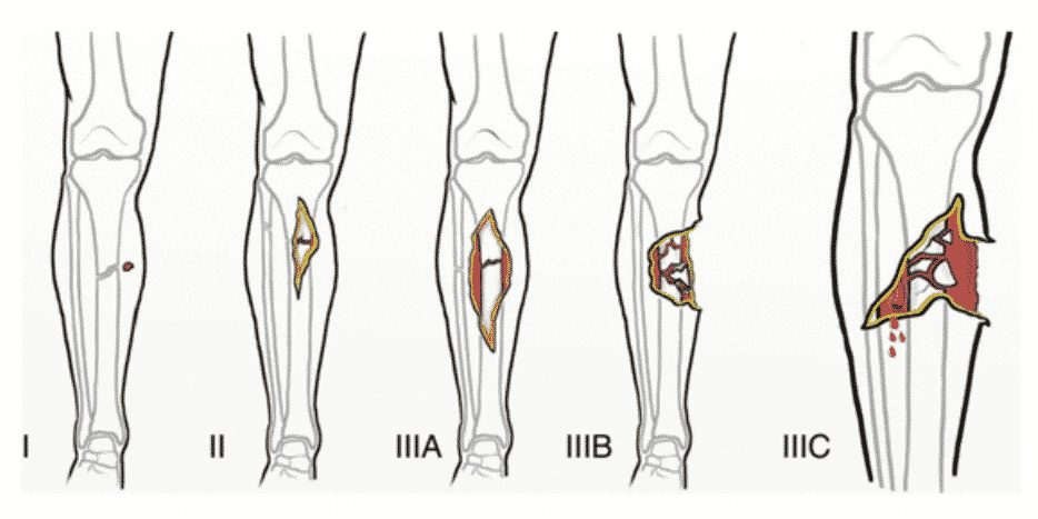 Soft Tissue Reconstruction In Lower Limb Trauma Overview