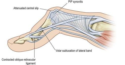 Swan Neck Deformity vs Boutonnières