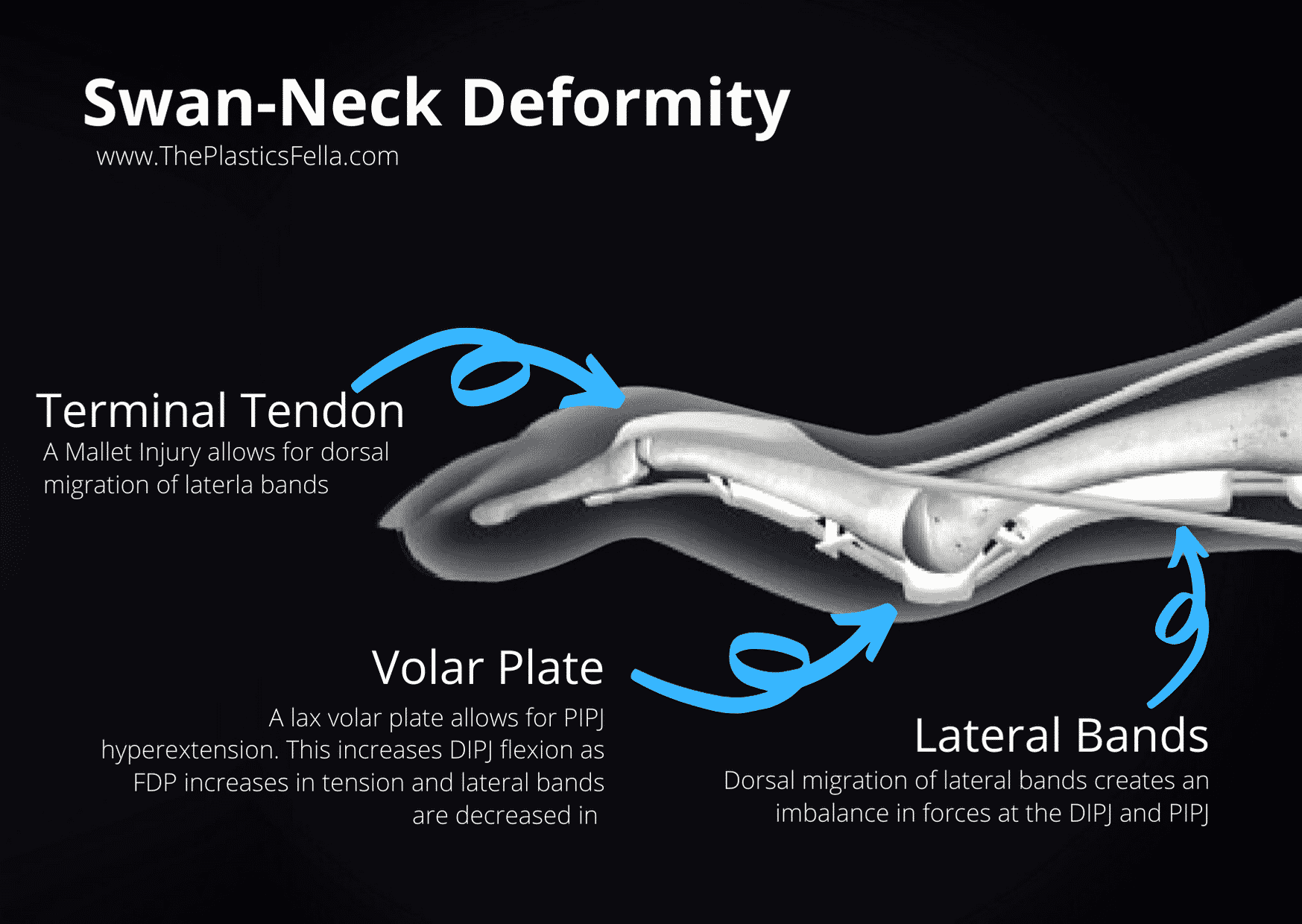 Swan Neck Deformity Vs Boutonnières