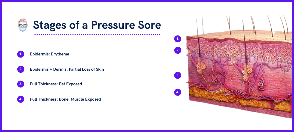 pressure-ulcers-sores-classification-illustrations-treatment