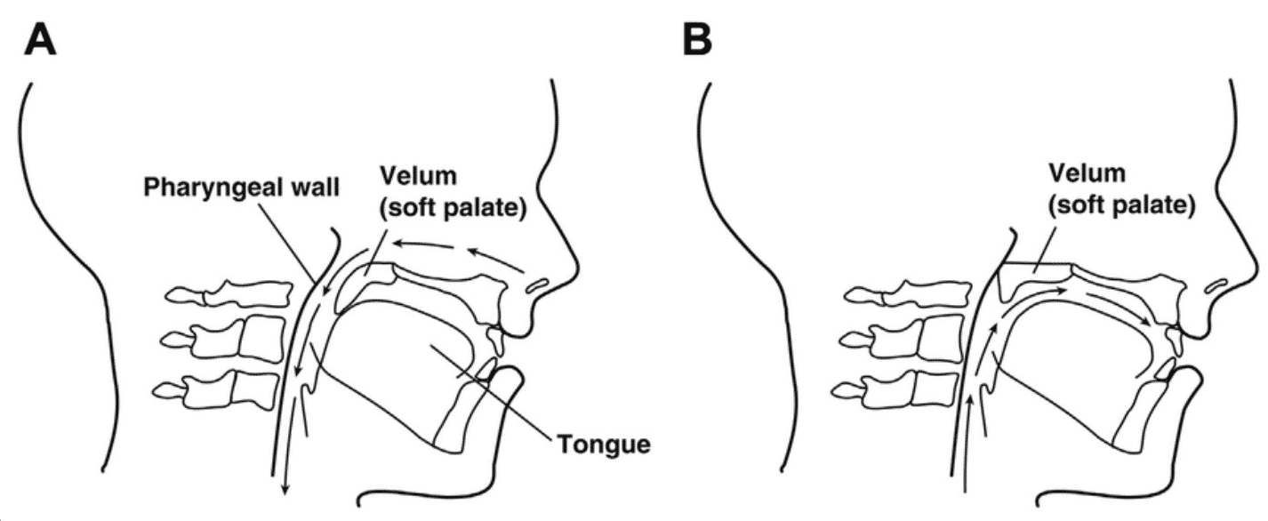 velopharyngeal-insufficiency