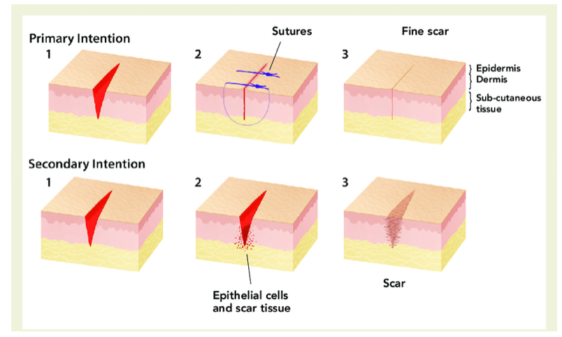 techniques-for-wound-closure