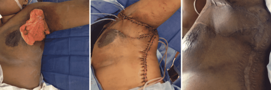 hidradenitis suppurativa surgery
