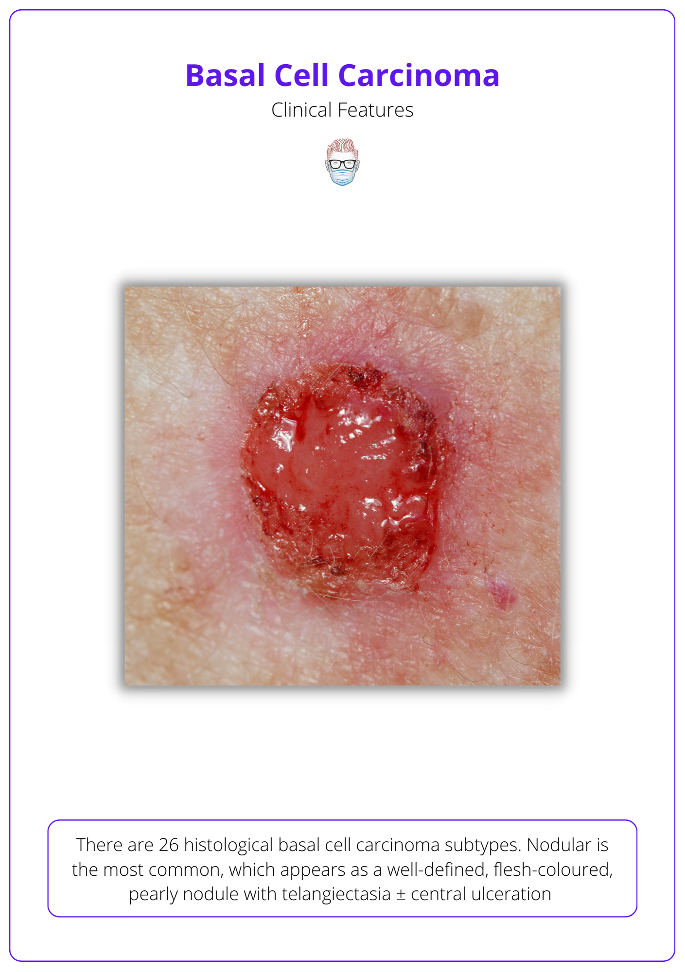 superficial basal cell carcinoma