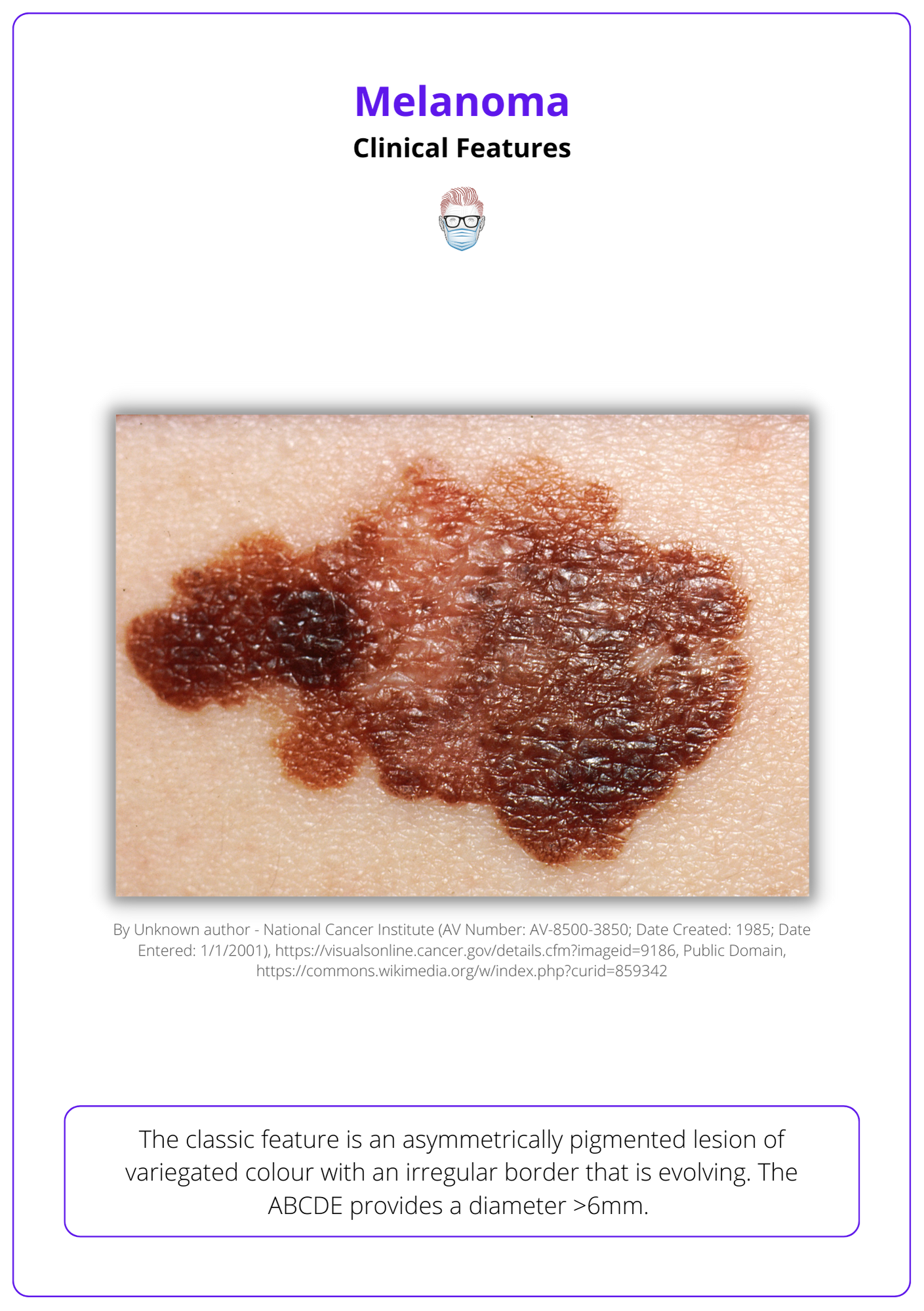 Melanoma • Diagnosis Features Sentinel Node Staging