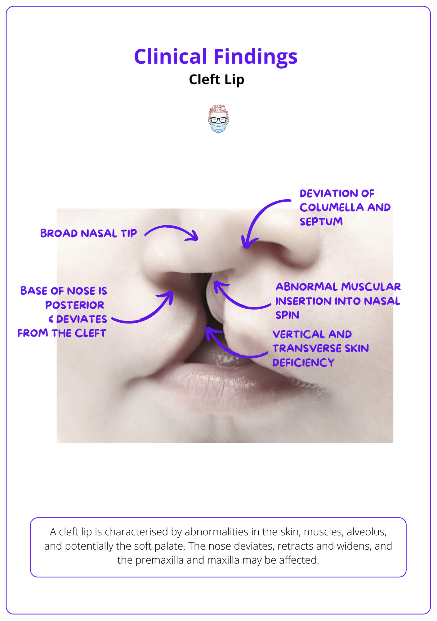 Clinical features of a cleft lip