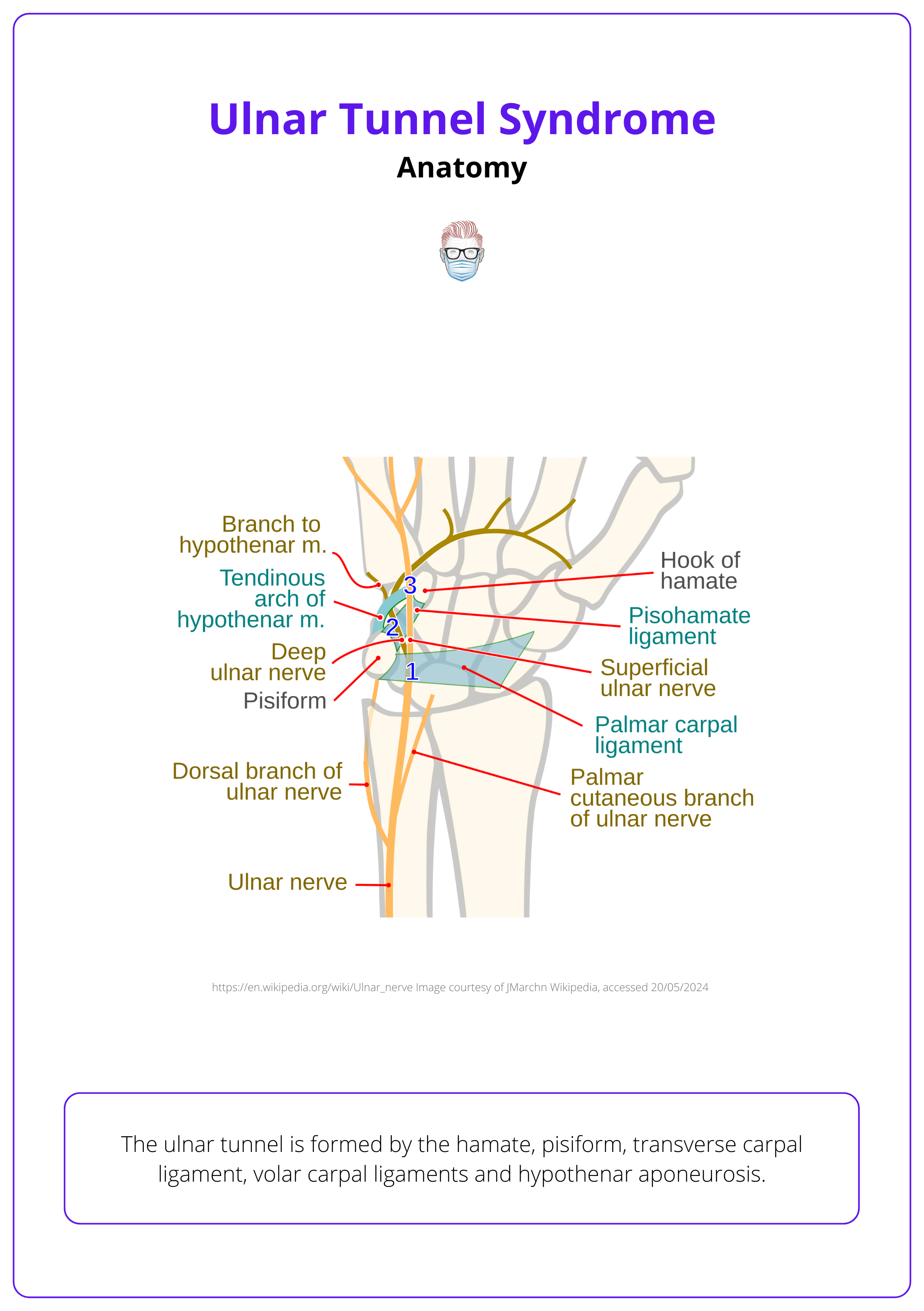 Anatomy of the ulnar tunnel, Ulnar Tunnel Syndrome