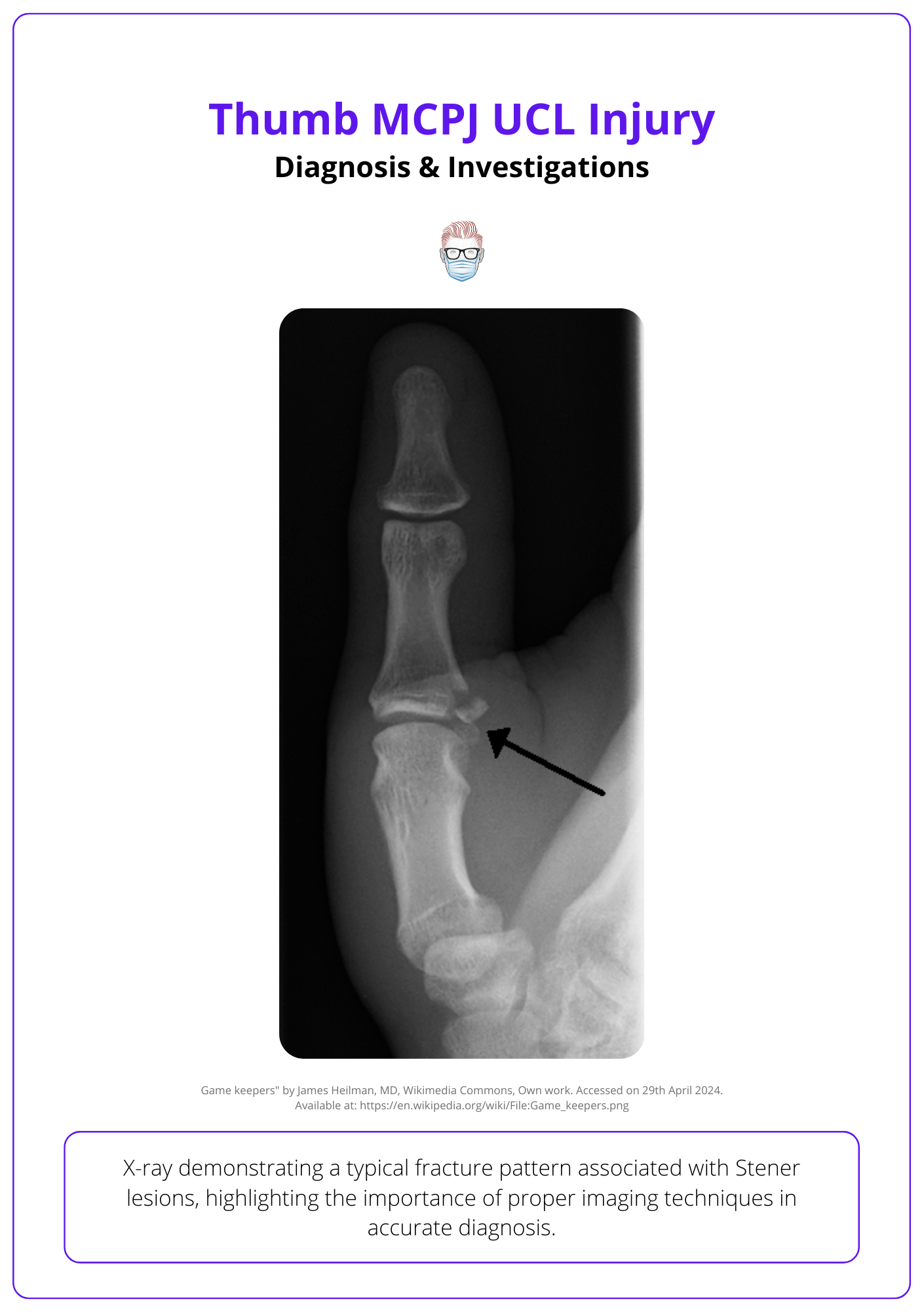 X-ray ulnar collateral avulsion fragment, Thumb MCPJ UCL Injury
