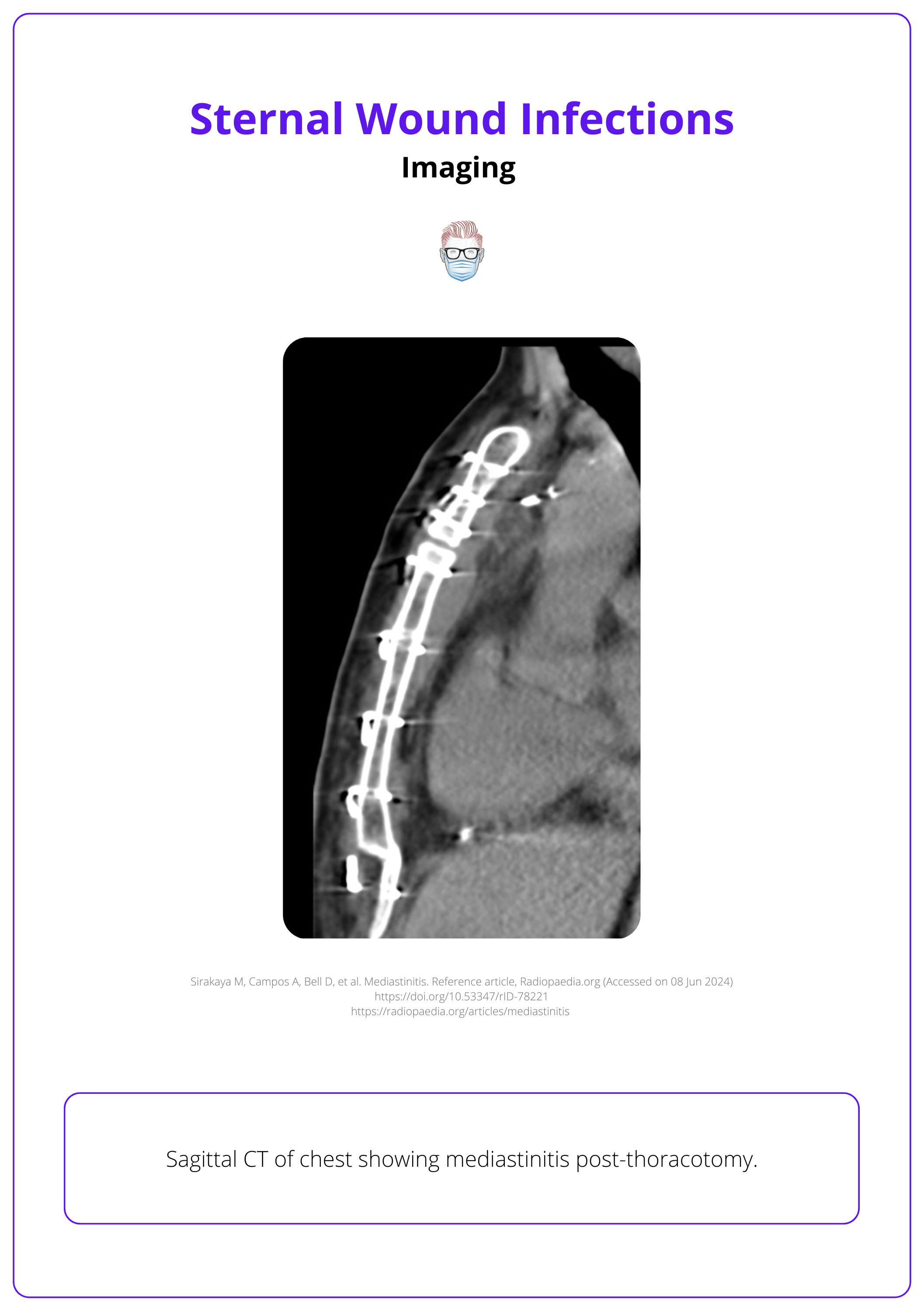 Mediastinitis on CT post-thoracotomy, Diagnosis of sternal wound infection