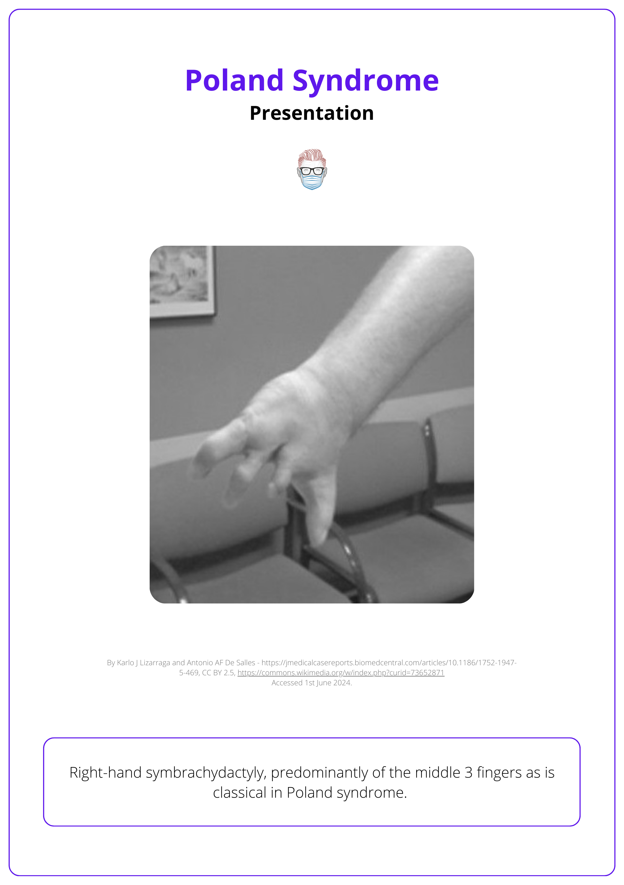 Right-hand symbrachydactyly in the presentation of Poland syndrome