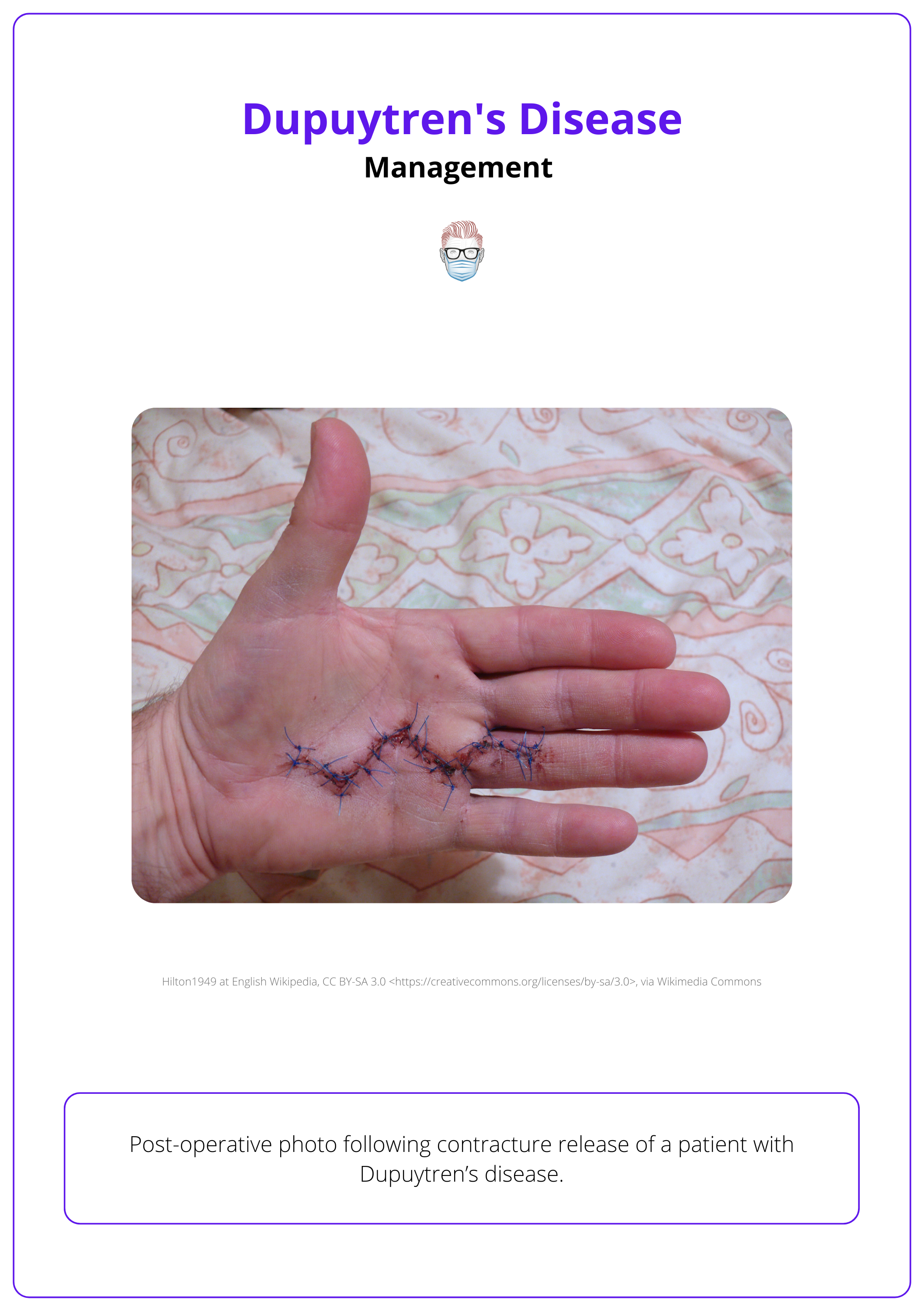 Contracture release for Dupuytren's disease, surgical treatment for Dupuytren's disease