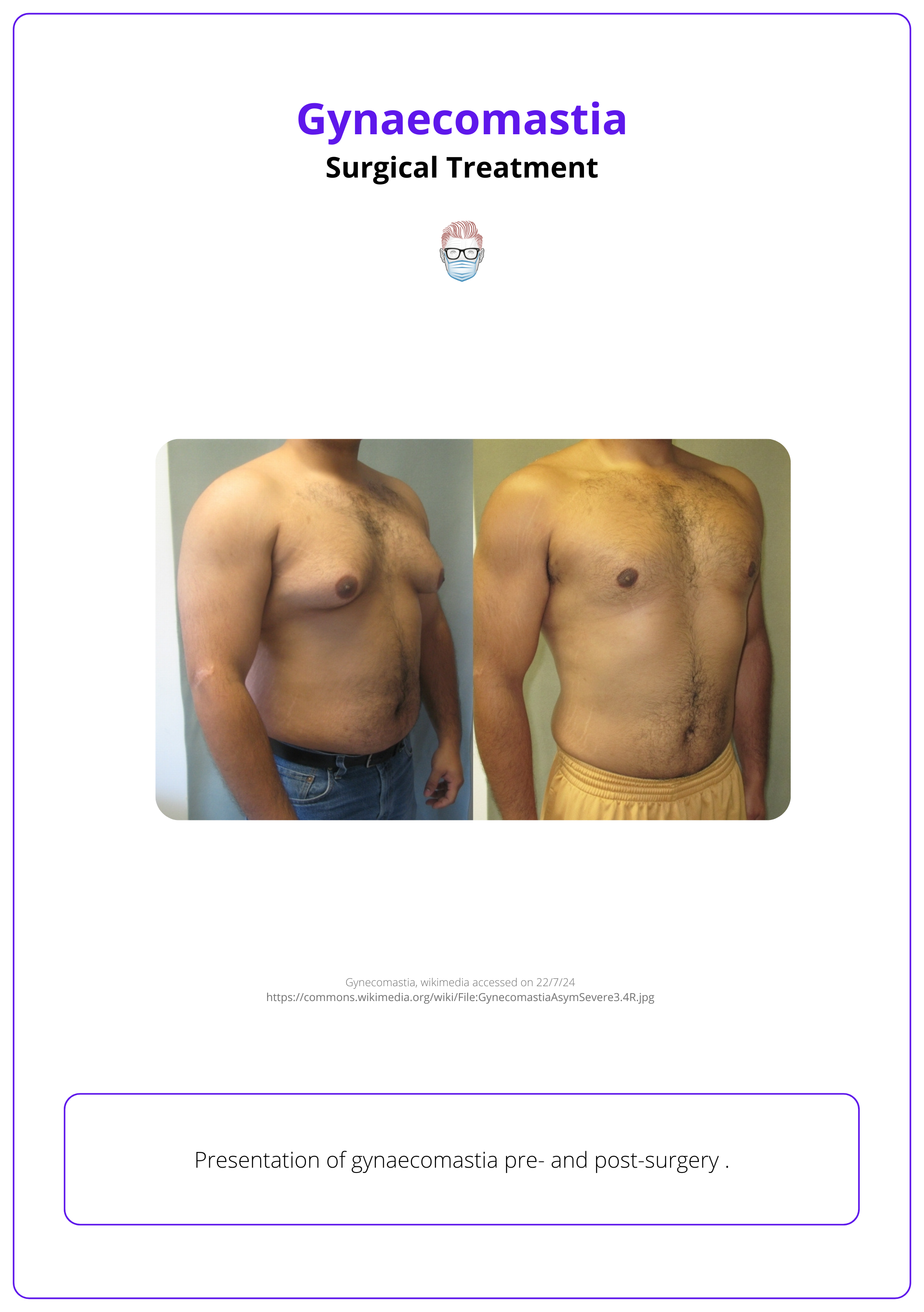 Gynaecomastia pre- and post-surgery.