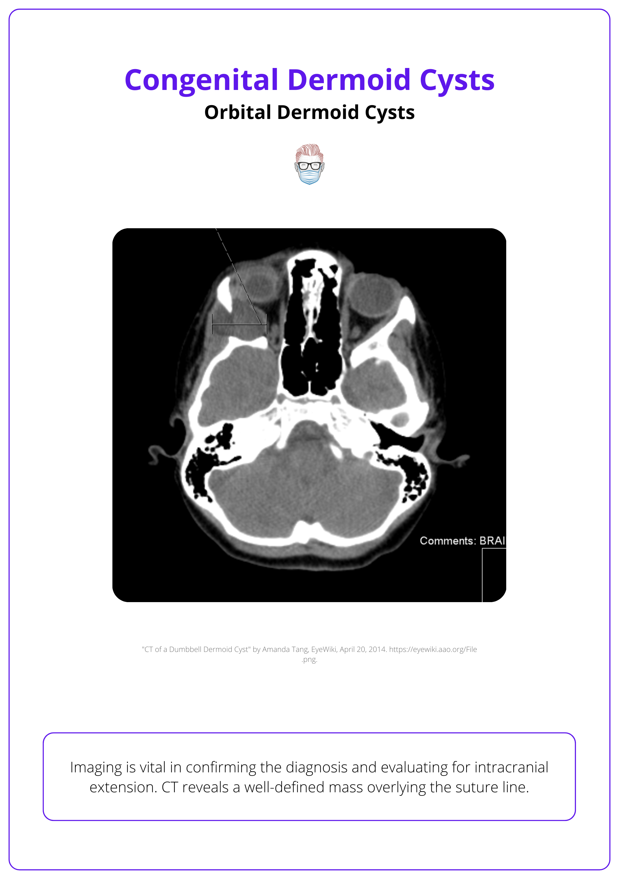 CT imaging of an orbital dermoid cyst