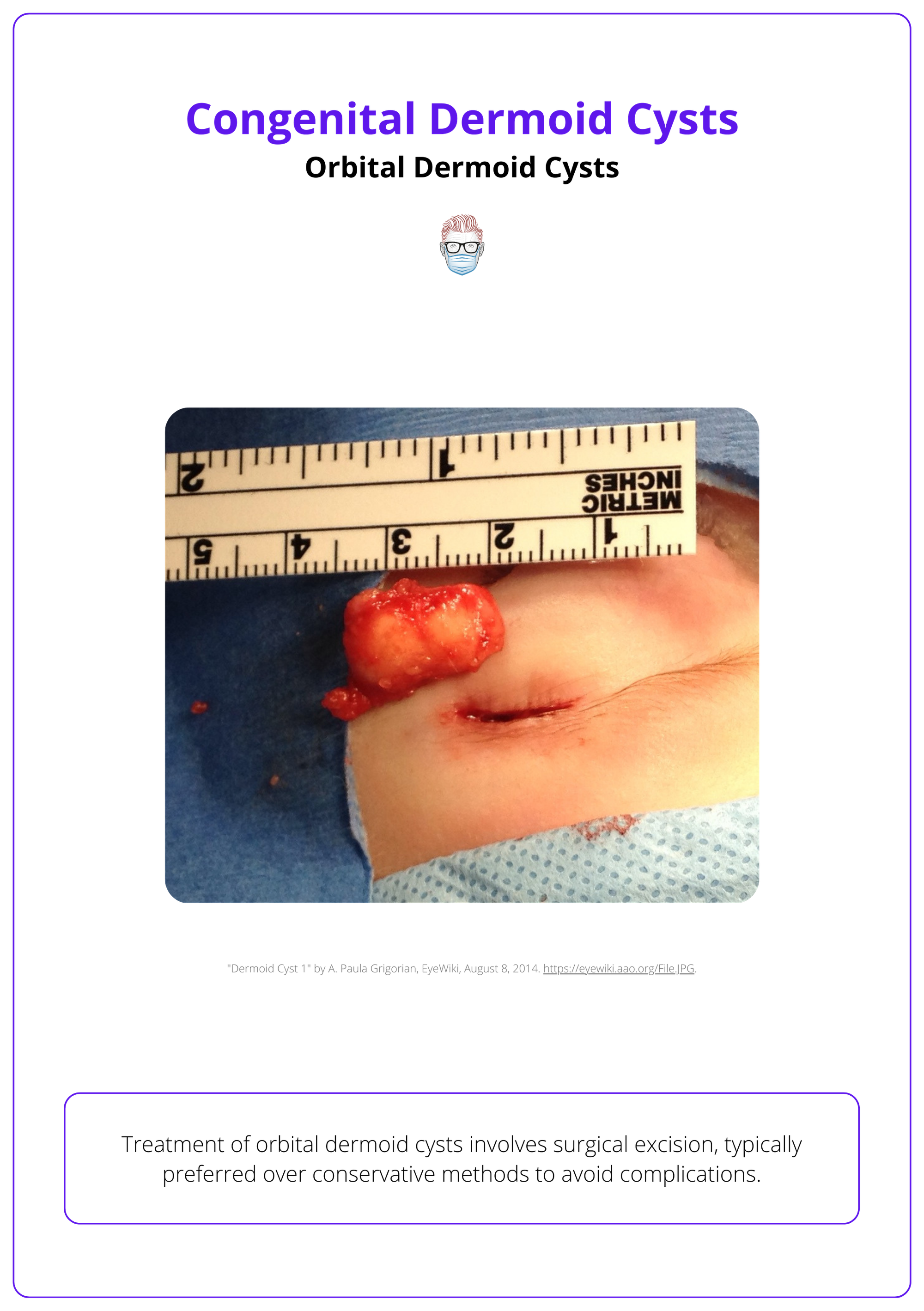 Surgical treatment of an orbital dermoid cyst, managing orbital dermoid cysts