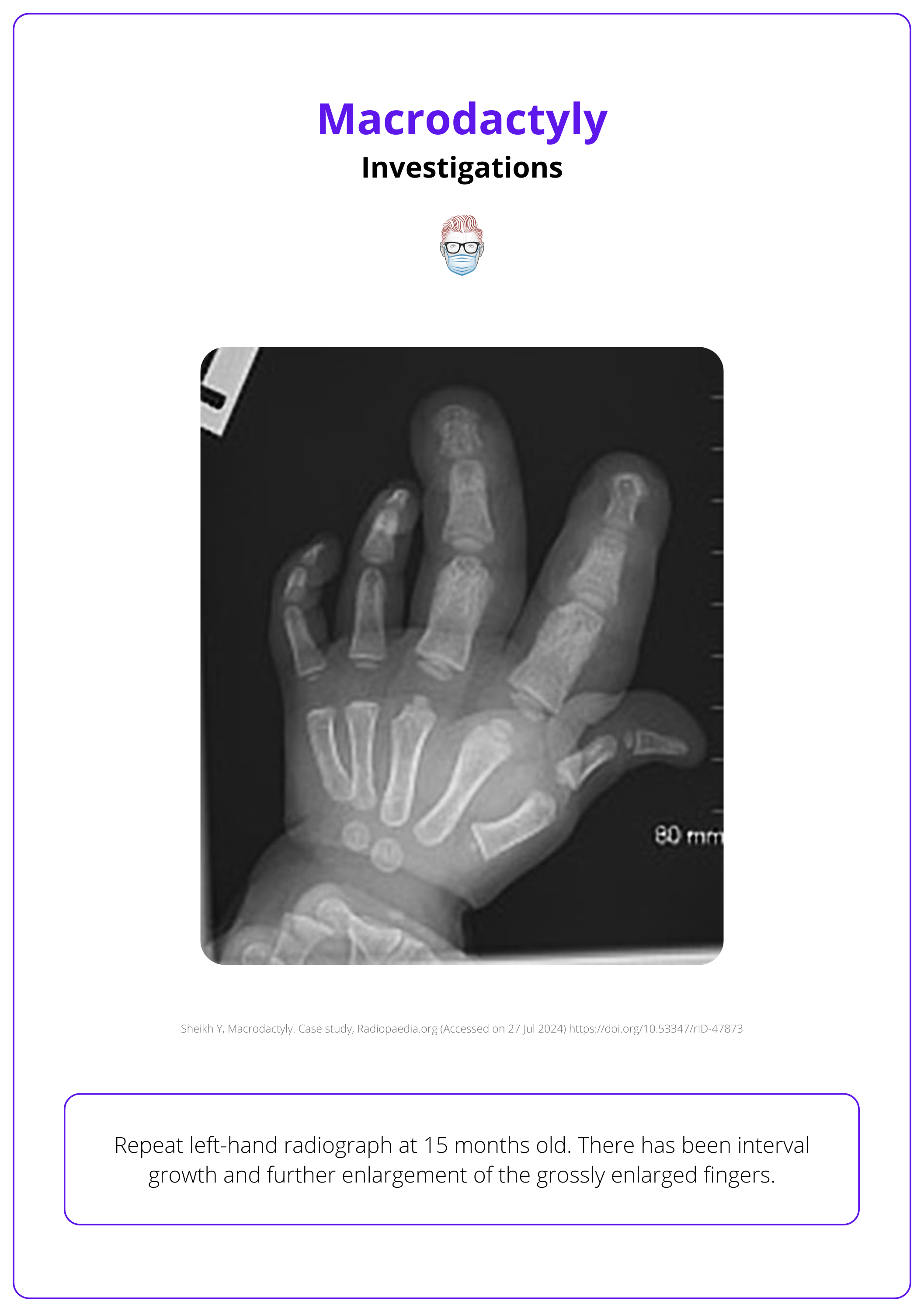 Left-hand radiograph - Macrodactyly investigations