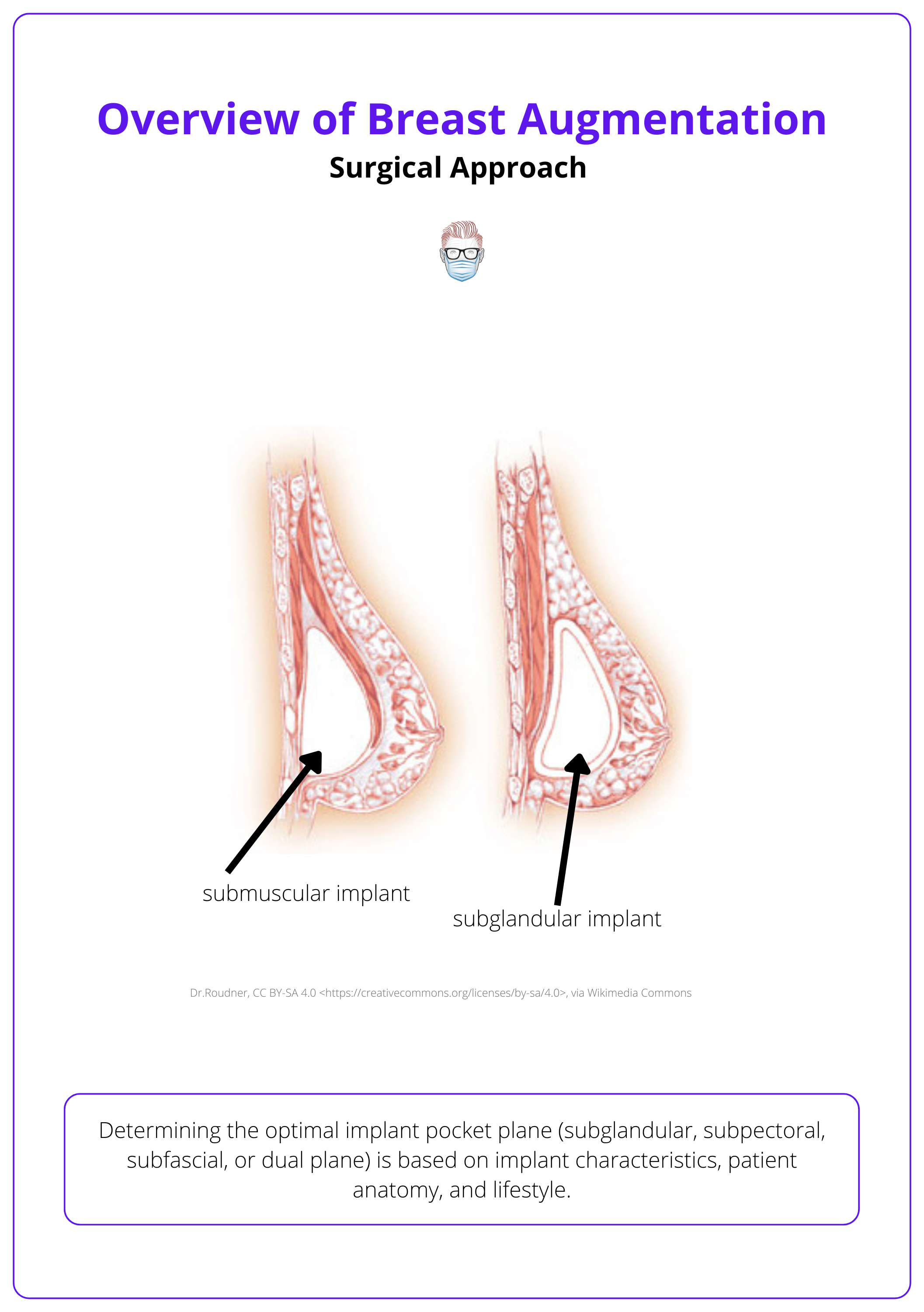 Implant pocket in the subpectoral and subglandular plane