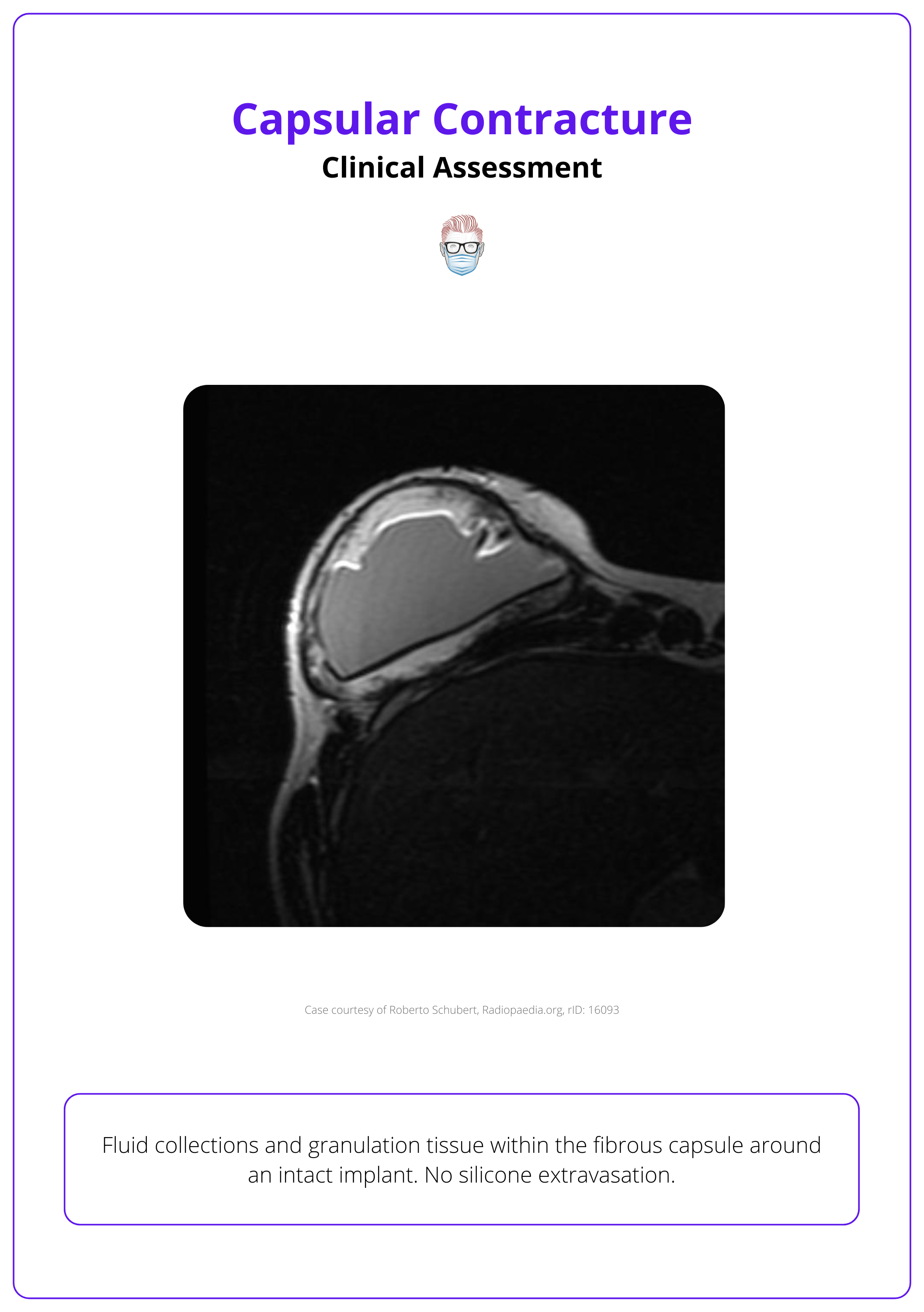 Fluid collections and granulation tissue within the fibrous capsule around an intact implant in capsular contracture