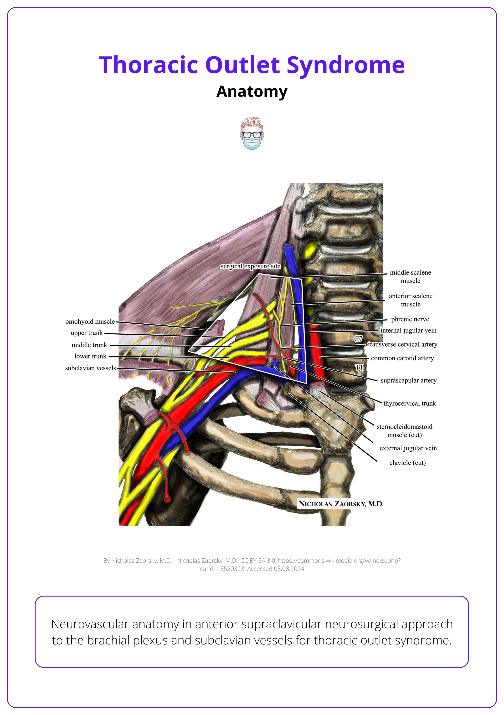 An illustration of the relevant neurovascular anatomy in anterior supraclavicular neurosurgical approach to the brachial plexus and subclavian vessels for thoracic outlet syndrome.