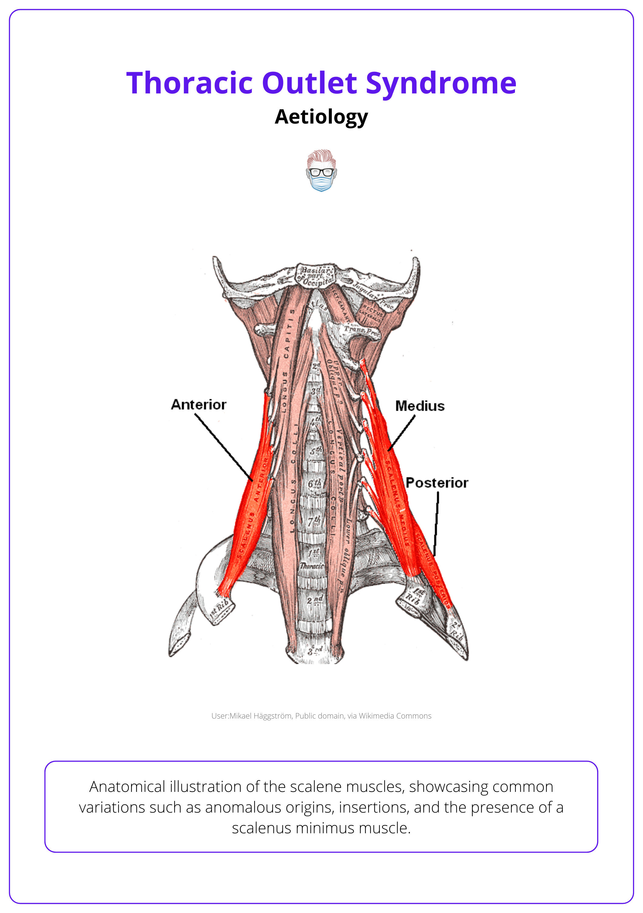 Anatomical illustration of the scalene muscles, showcasing common variations such as anomalous origins, insertions, and the presence of a scalenus minimus muscle.