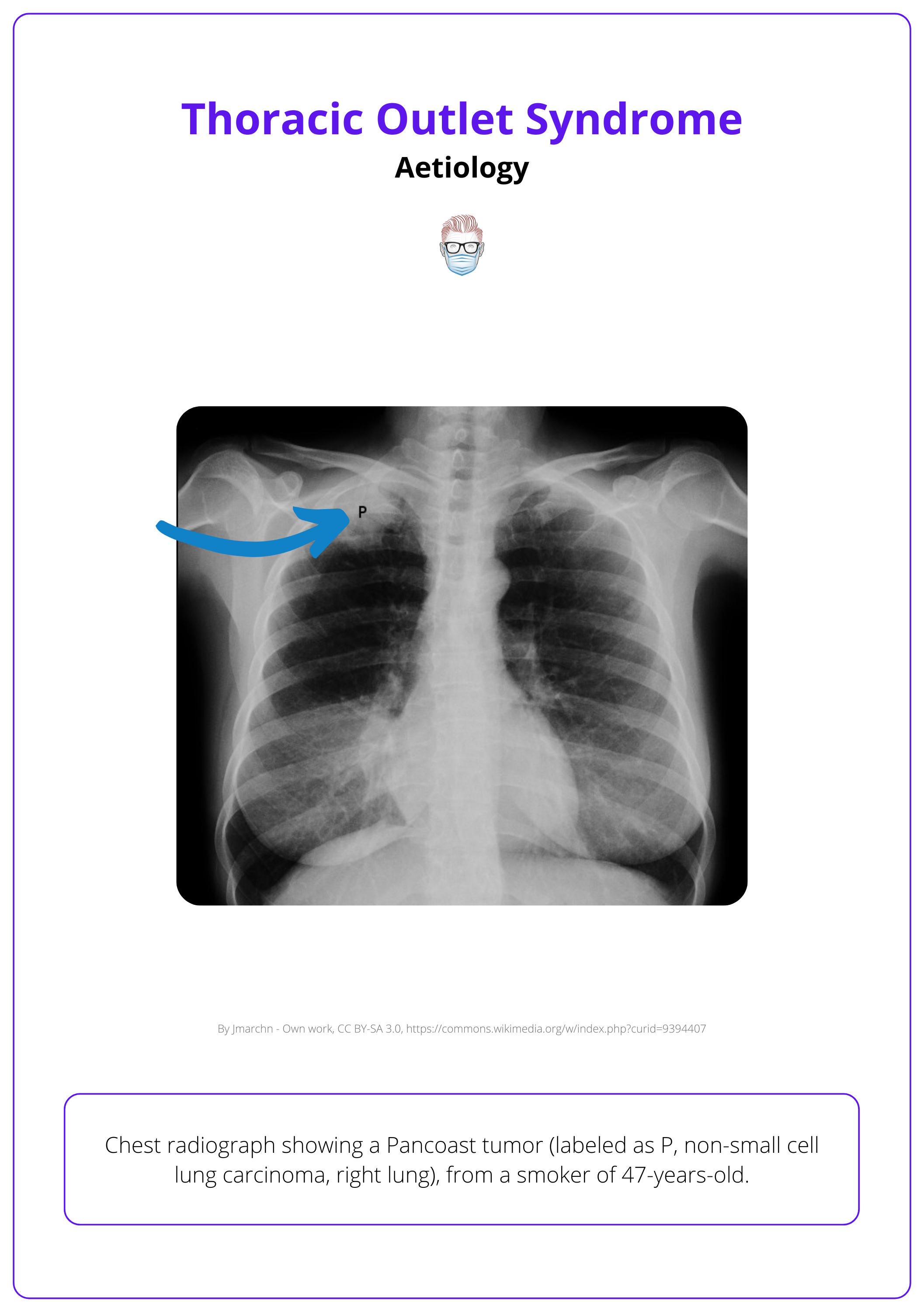 Chest radiograph showing a Pancoast tumor (labeled as P, non-small cell lung carcinoma, right lung), from a smoker of 47-years-old.