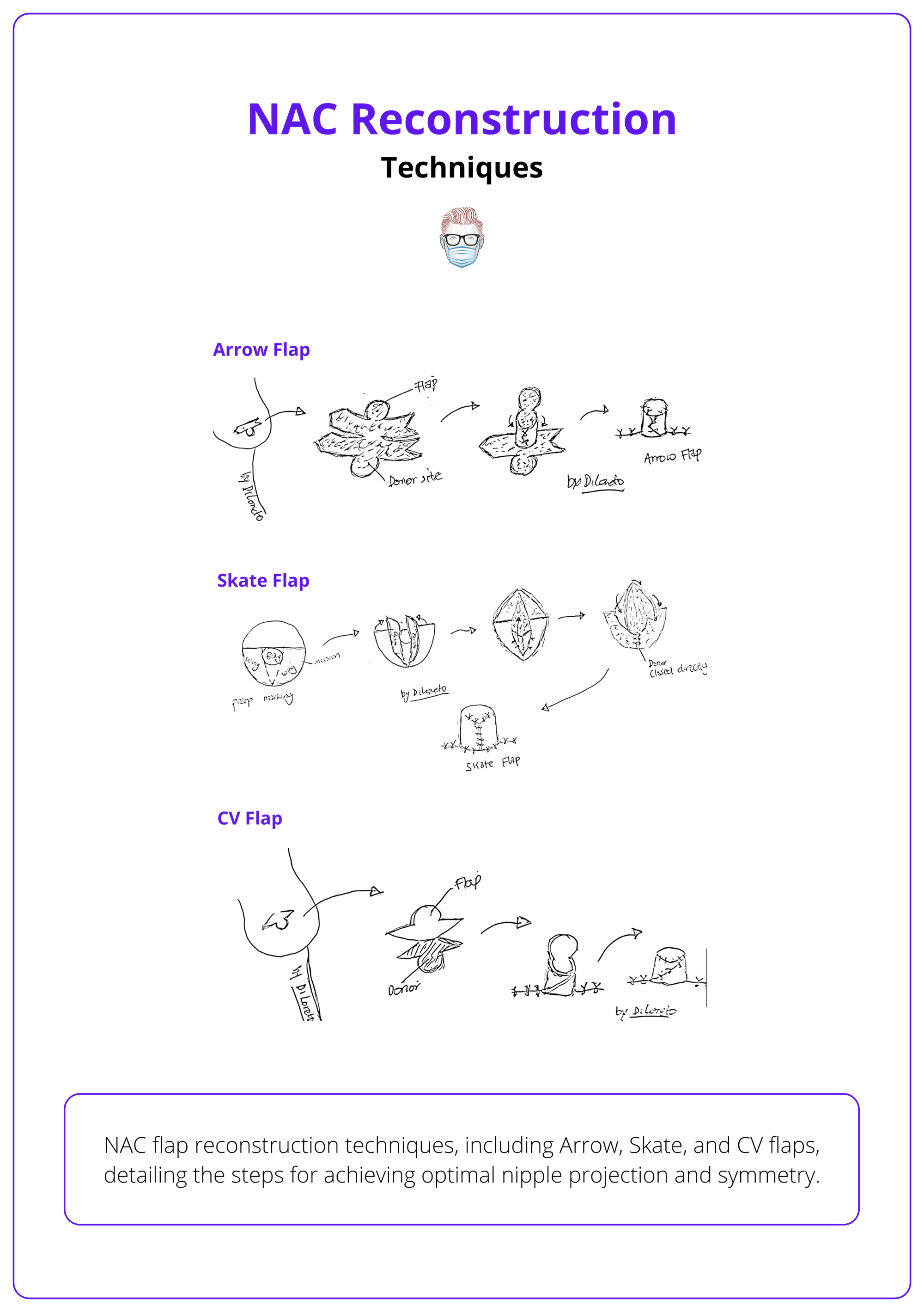 Illustration of NAC flap reconstruction techniques, including Arrow, Skate, and CV flaps, detailing the steps of flap raising, inset, and closure for achieving optimal nipple projection and symmetry.