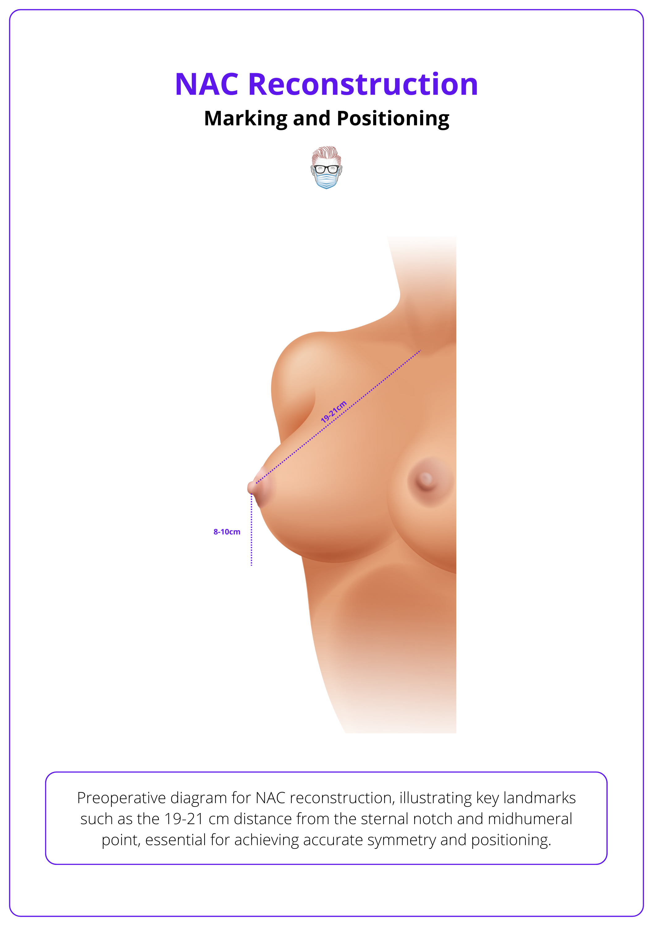 Preoperative diagram for NAC reconstruction, illustrating key landmarks such as the 19-21 cm distance from the sternal notch and midhumeral point, essential for achieving accurate symmetry and positioning.