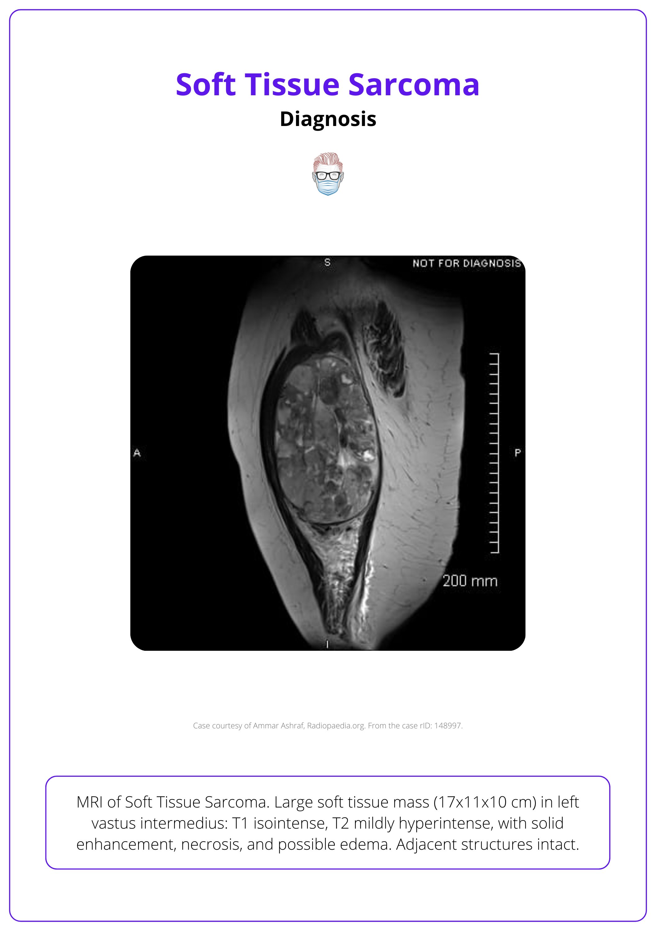 MRI of Soft Tissue Sarcoma for the diagnosis