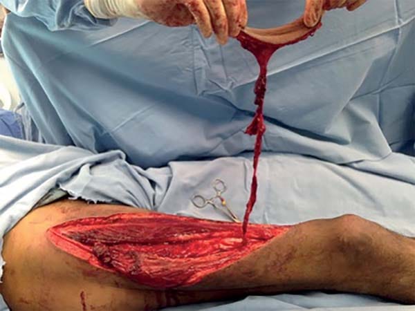 Mobilization of the flap, Reverse anterolateral thigh flap.