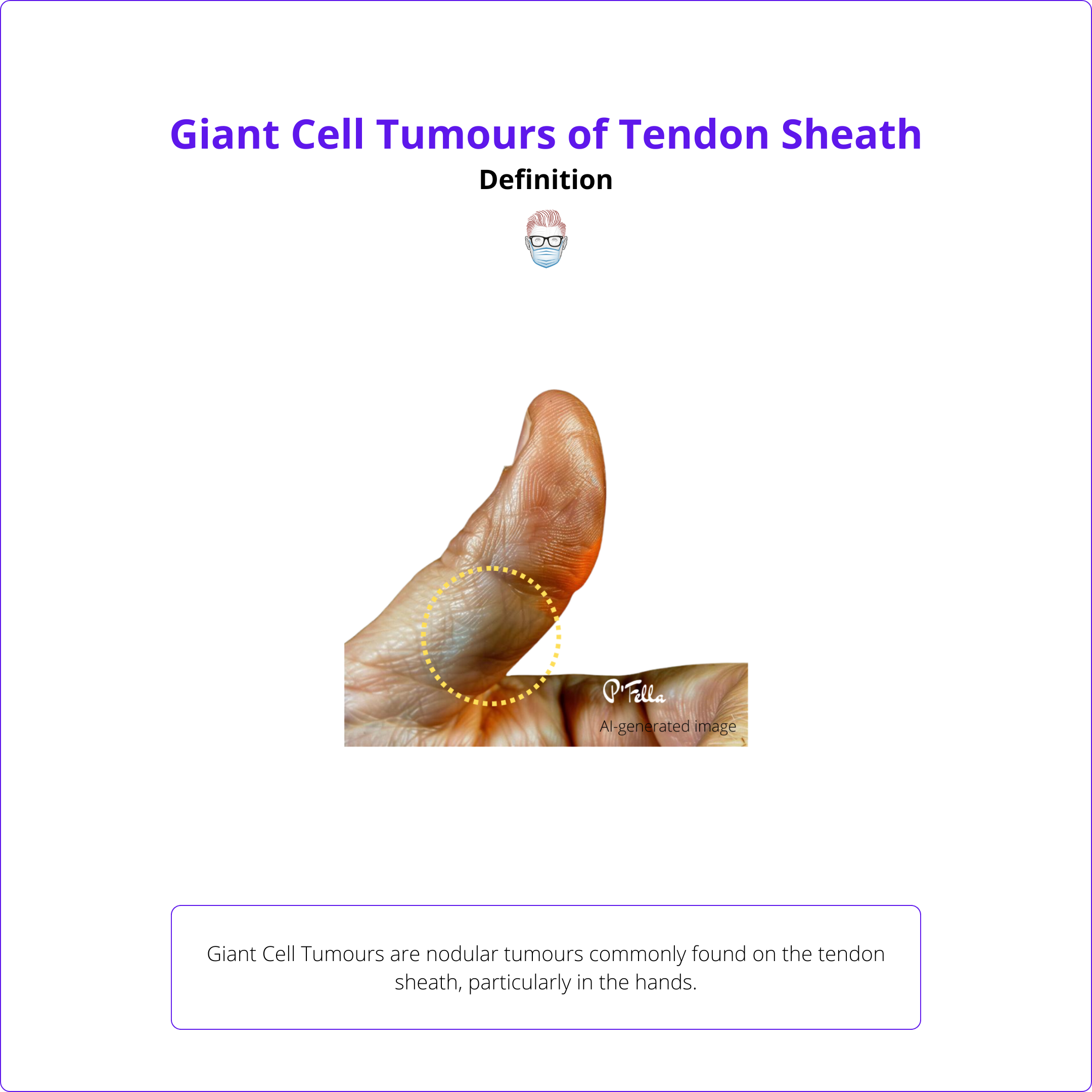 Giant Cell Tumours of the Tendon Sheath