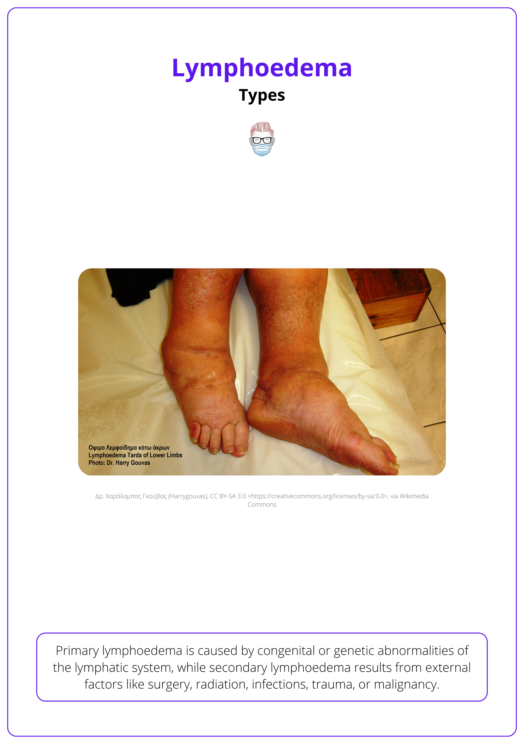 Bilateral lymphoedema, primary lymphoedema