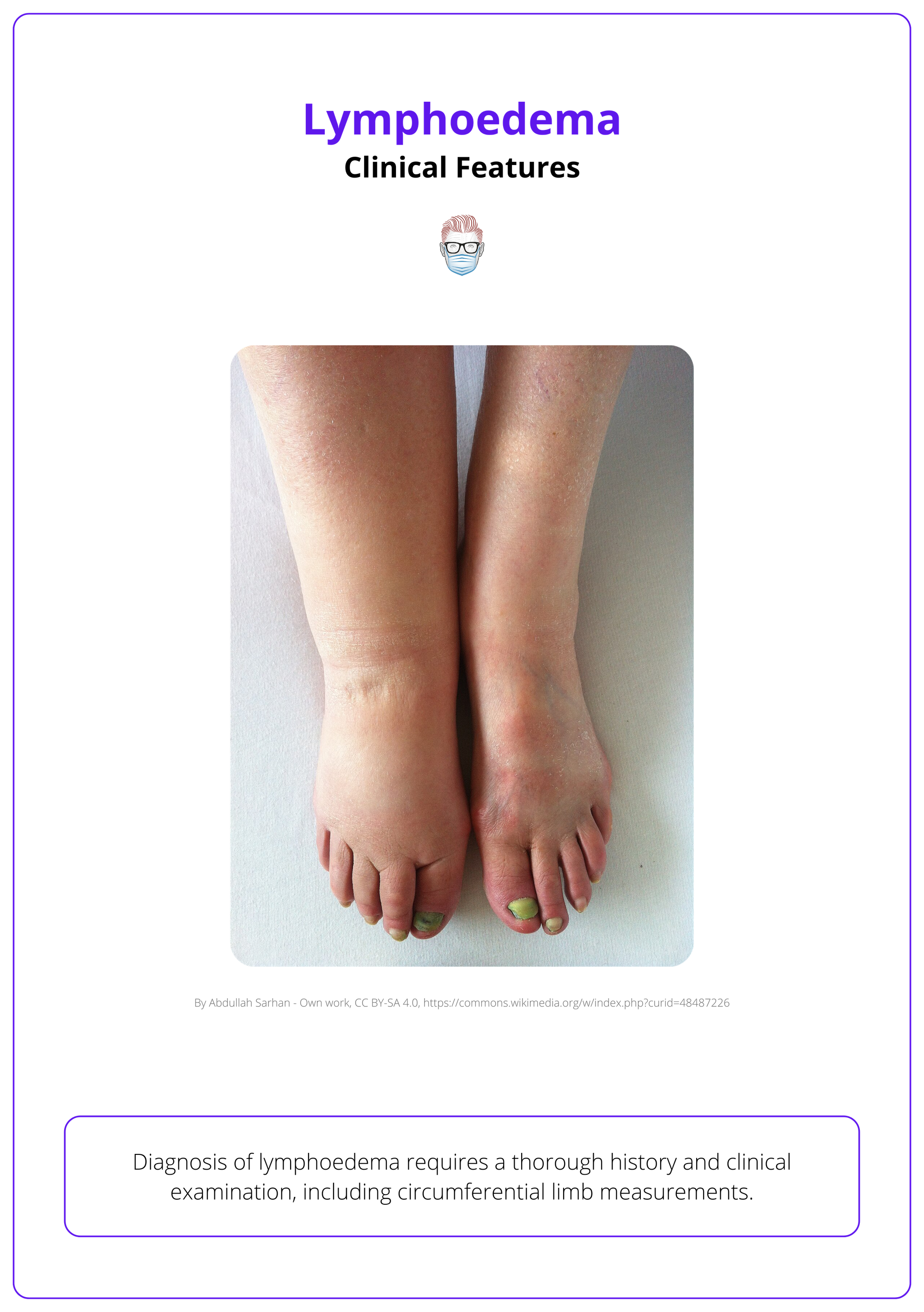 Diagnosis of lymphoedema requires a circumferential limb measurements