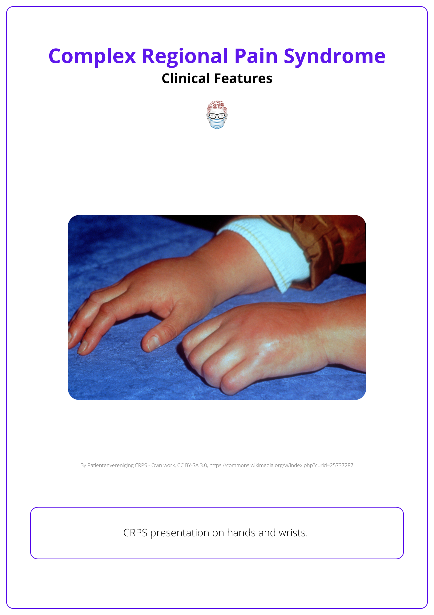 Clinical presentation of CRPS of the hand and wrist