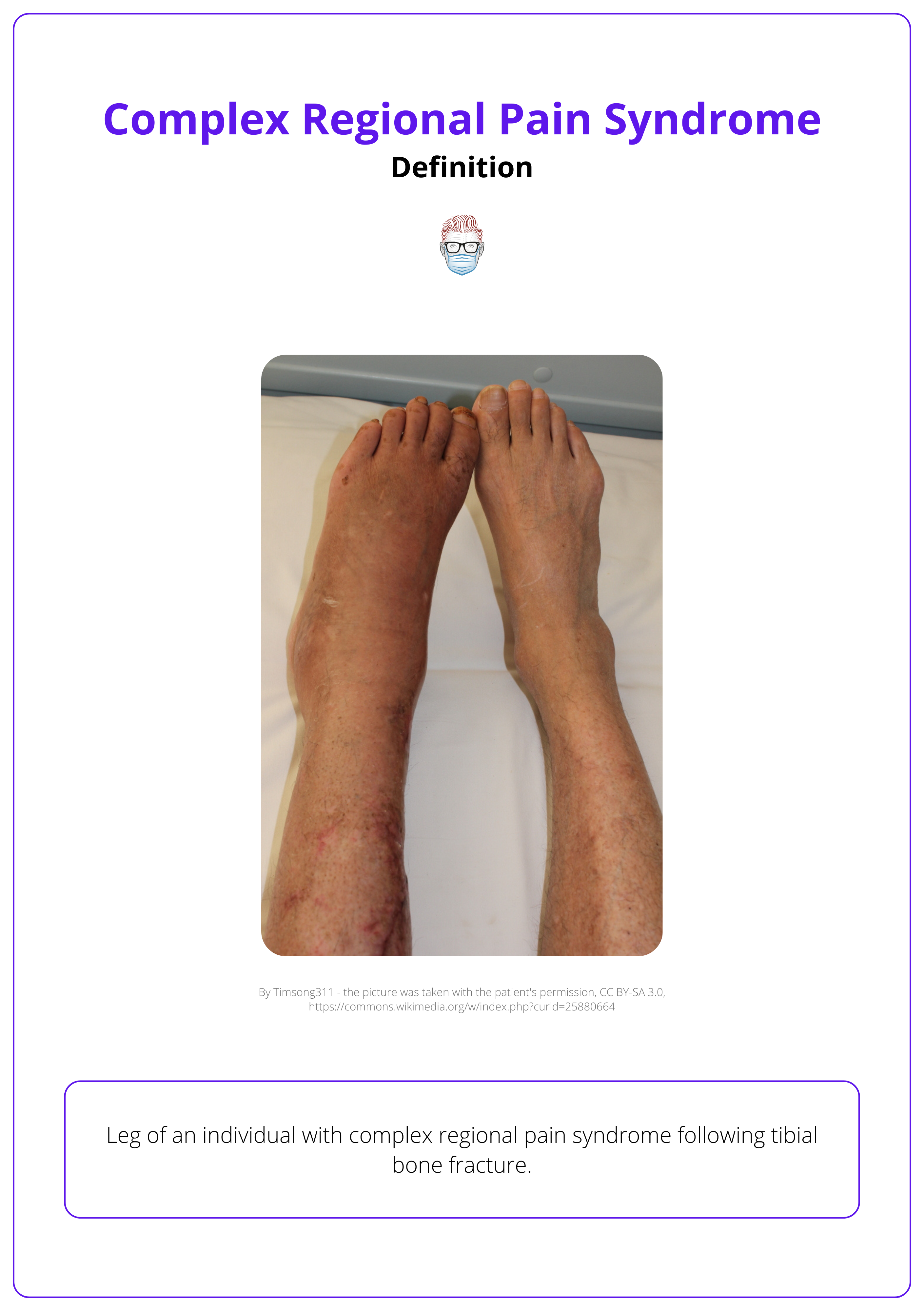 Complex Regional Pain Syndrome (CRPS) of the leg following tibial bone fracture