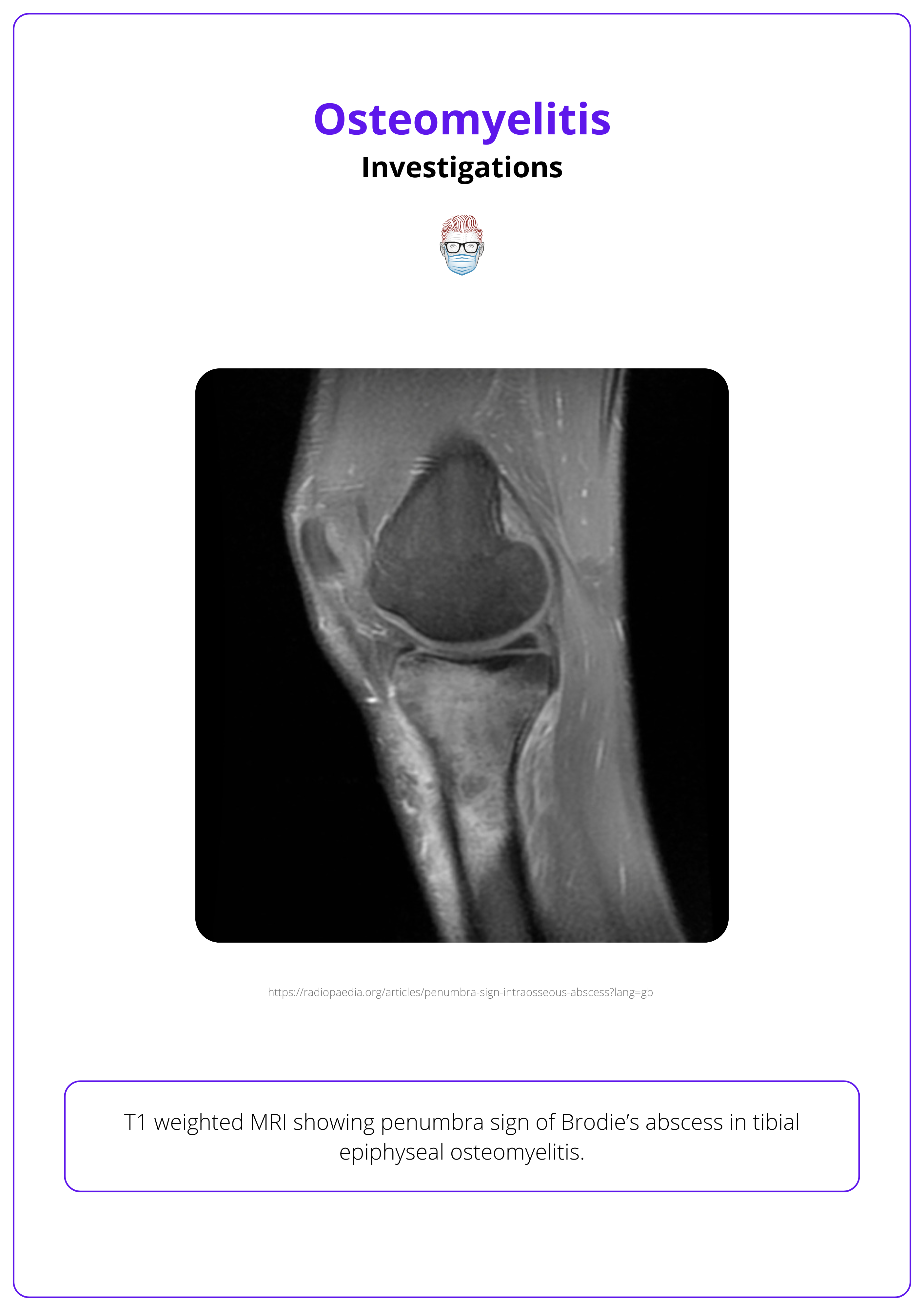 T1 weighted MRI showing penumbra sign of Brodie’s abscess in tibial epiphyseal osteomyelitis.