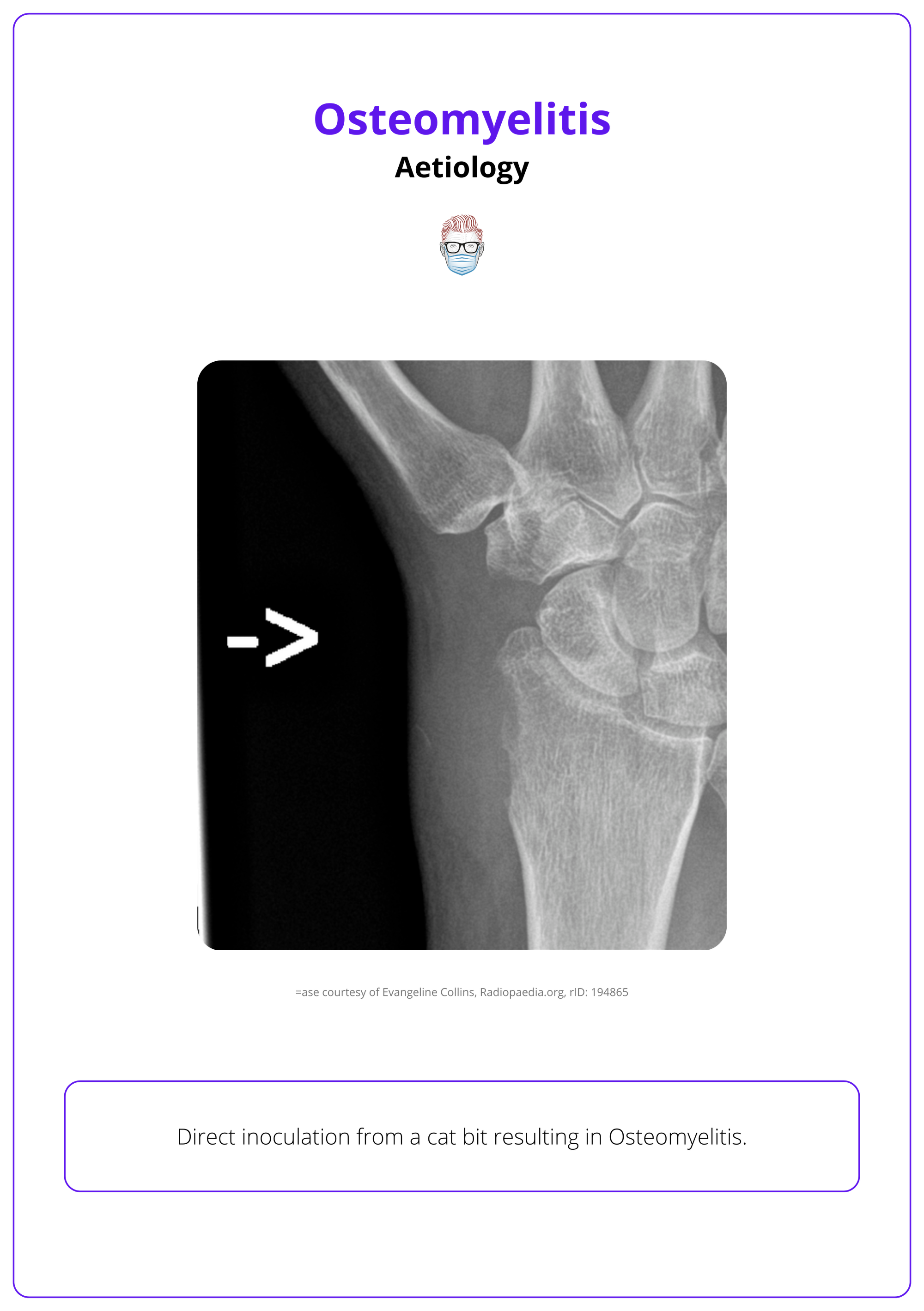 Direct inoculation from a cat bit resulting in Osteomyelitis