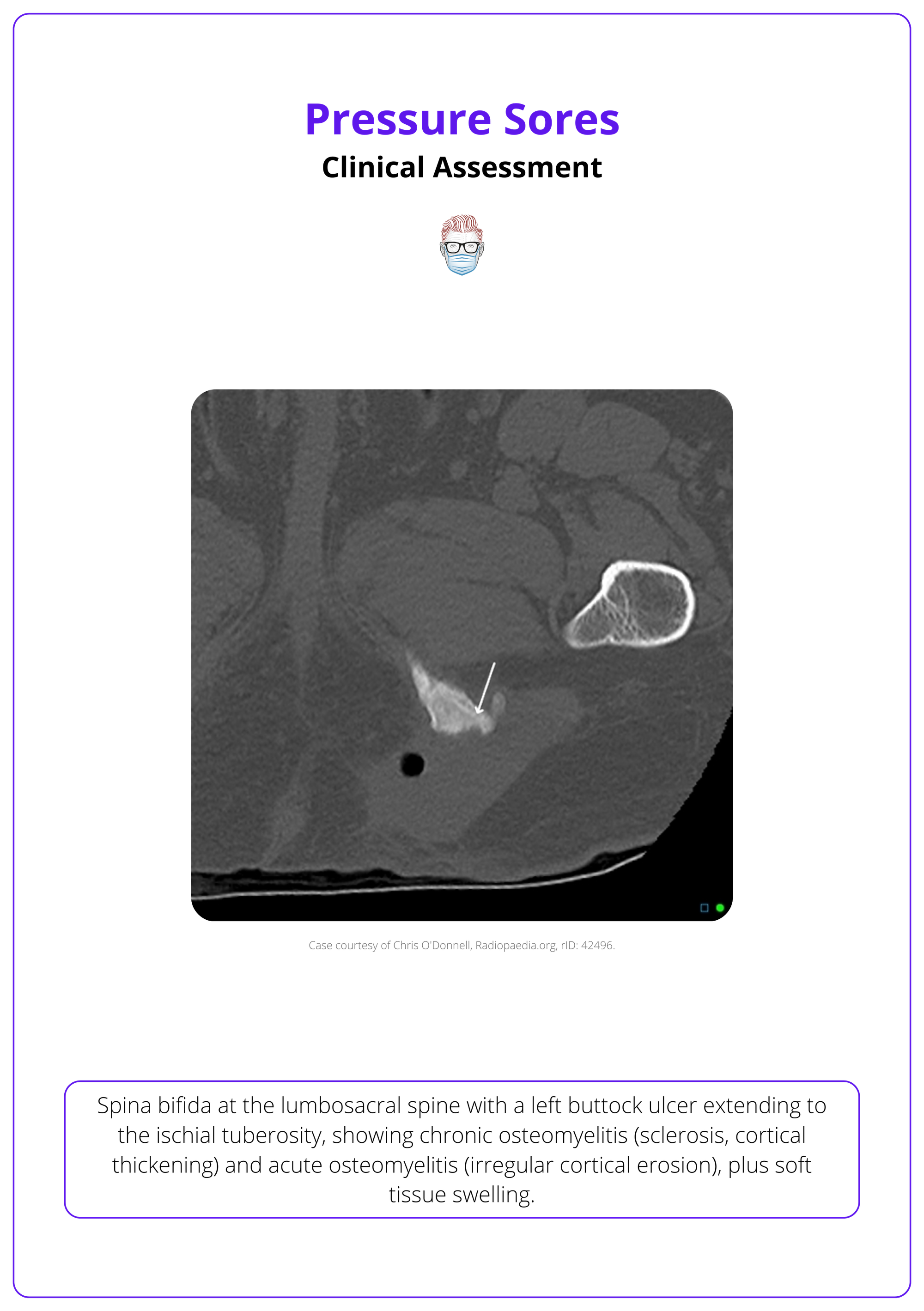 Spina bifida at the lumbosacral spine with a left buttock ulcer extending to the ischial tuberosity, pressure sores clinical assessment