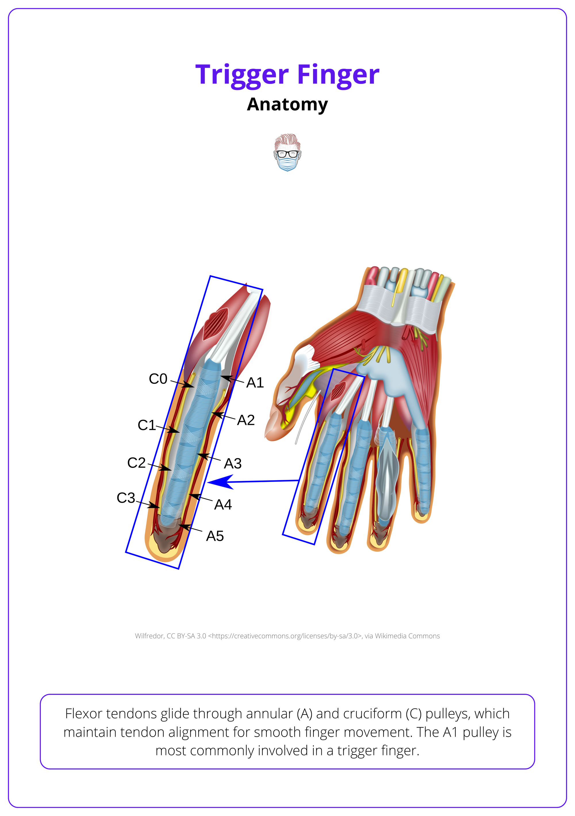 Anatomy of a trigger finger - The A1 pulley is most commonly involved in trigger finger.