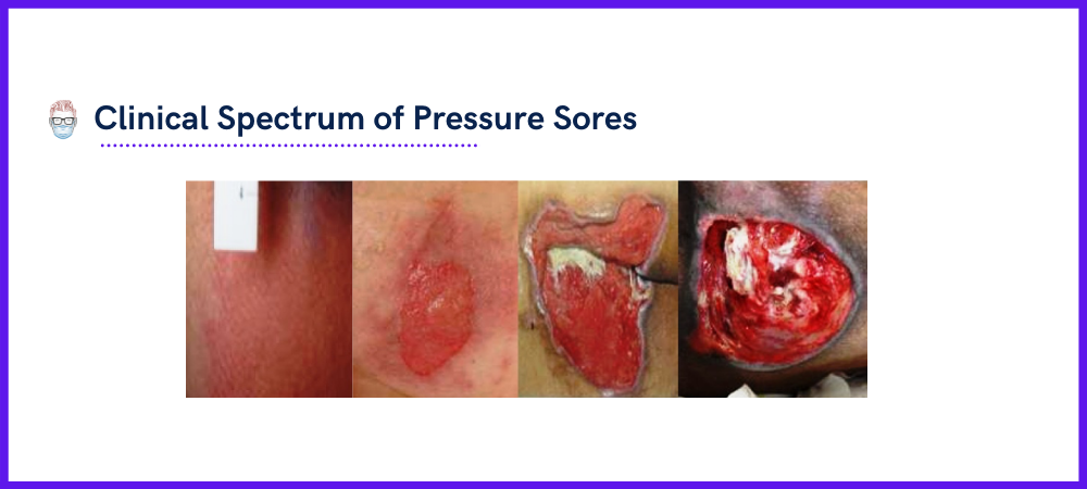 Clinical Spectrum of Pressure Sores (Grades 1-4)