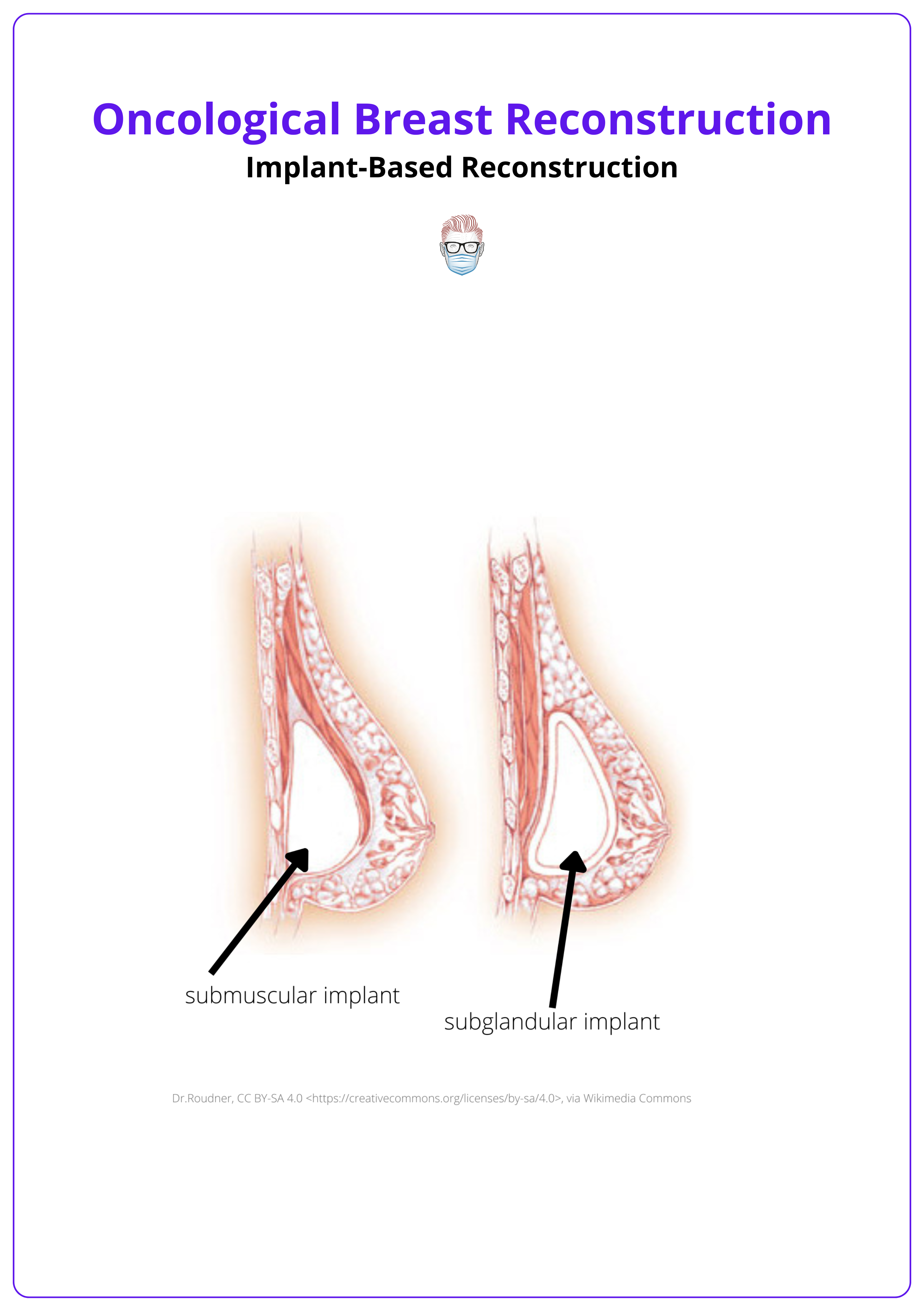 Implant pocket in the subpectoral and subglandular plane