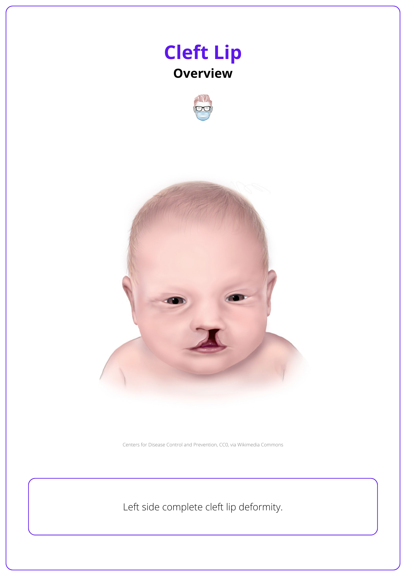 Left side complete cleft lip deformity, Facial Cleft, cleft palate, congenital