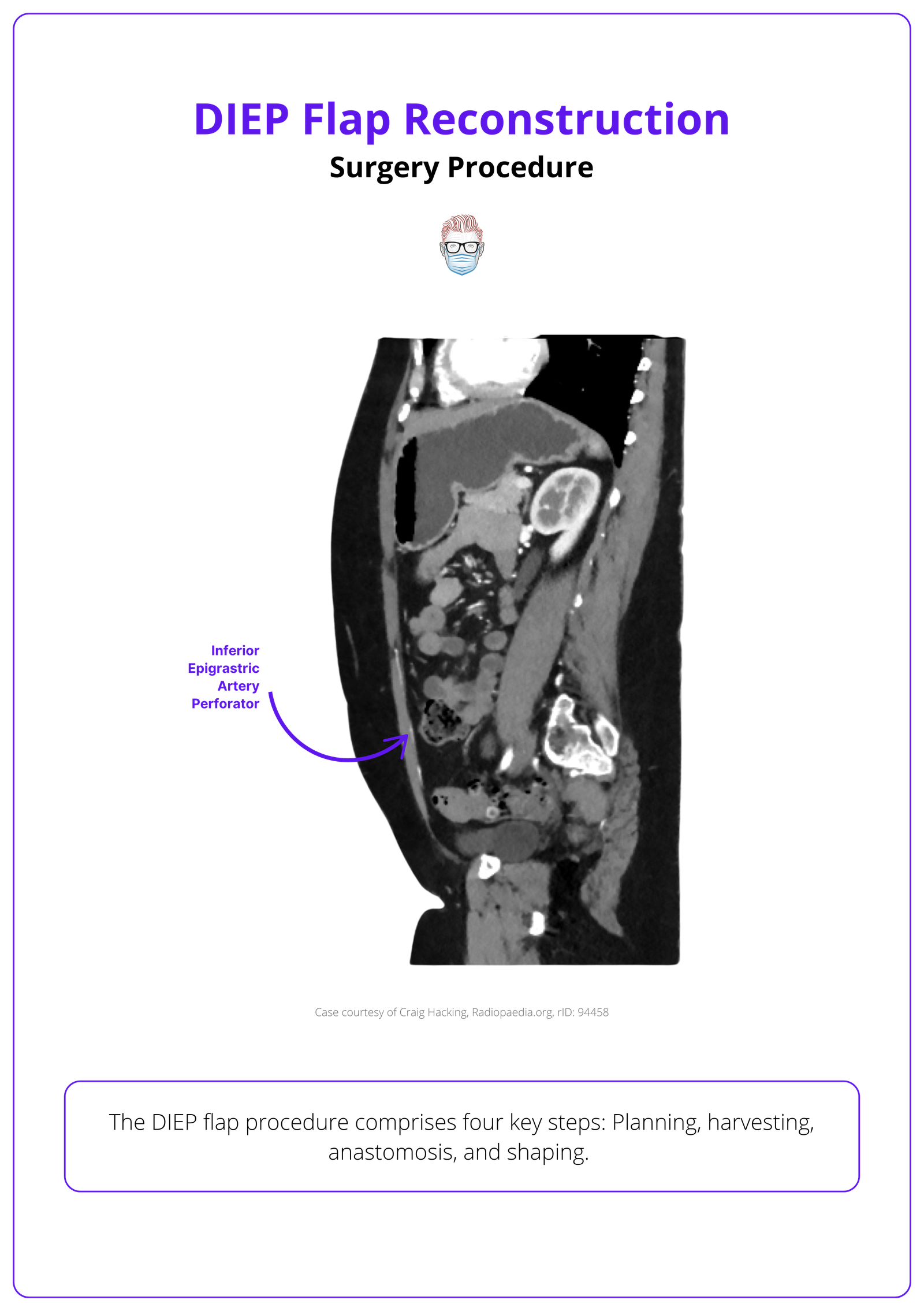 Marking and imaging for DIEP flap reconstruction