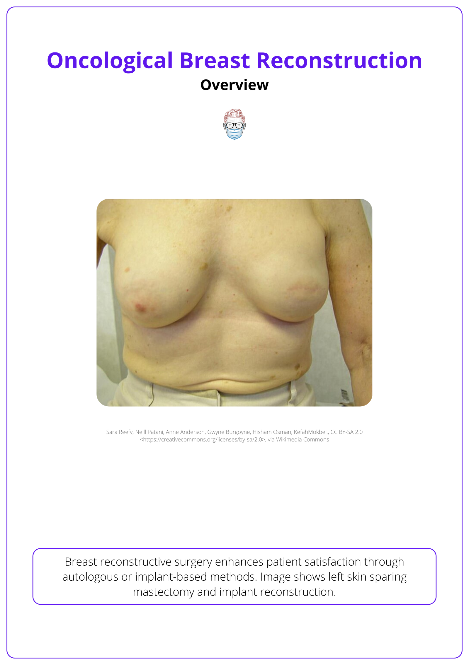 Left skin sparing mastectomy and implant reconstruction