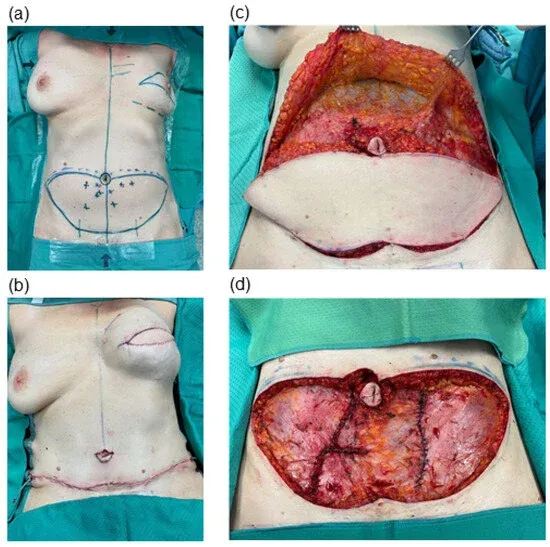 Intraoperative photo documentation of abdominal DIEP flap harvesting