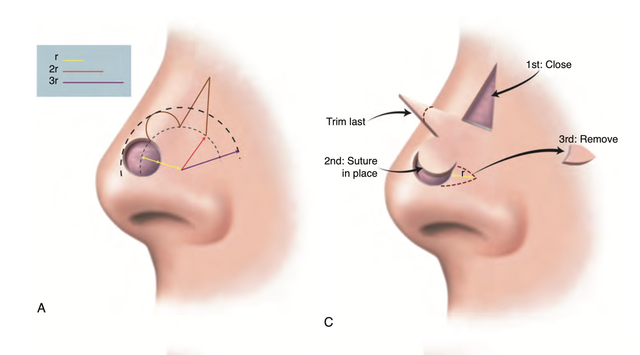 Bilobed flaps for nasal reconstruction