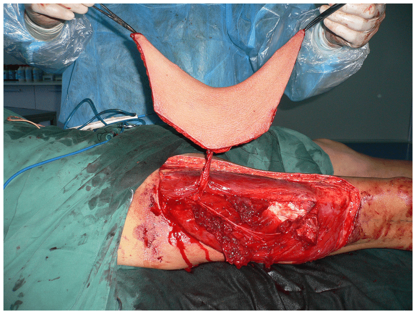 Intraoperative view after elevation of the ALT musculocutaneous perforator flap with the deep fascia