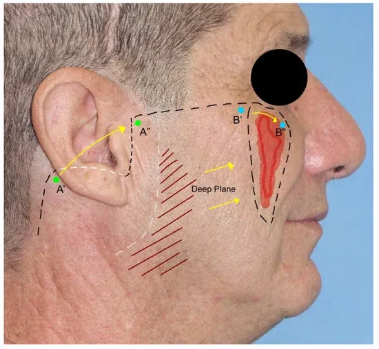 Designing a cervicofacial flap