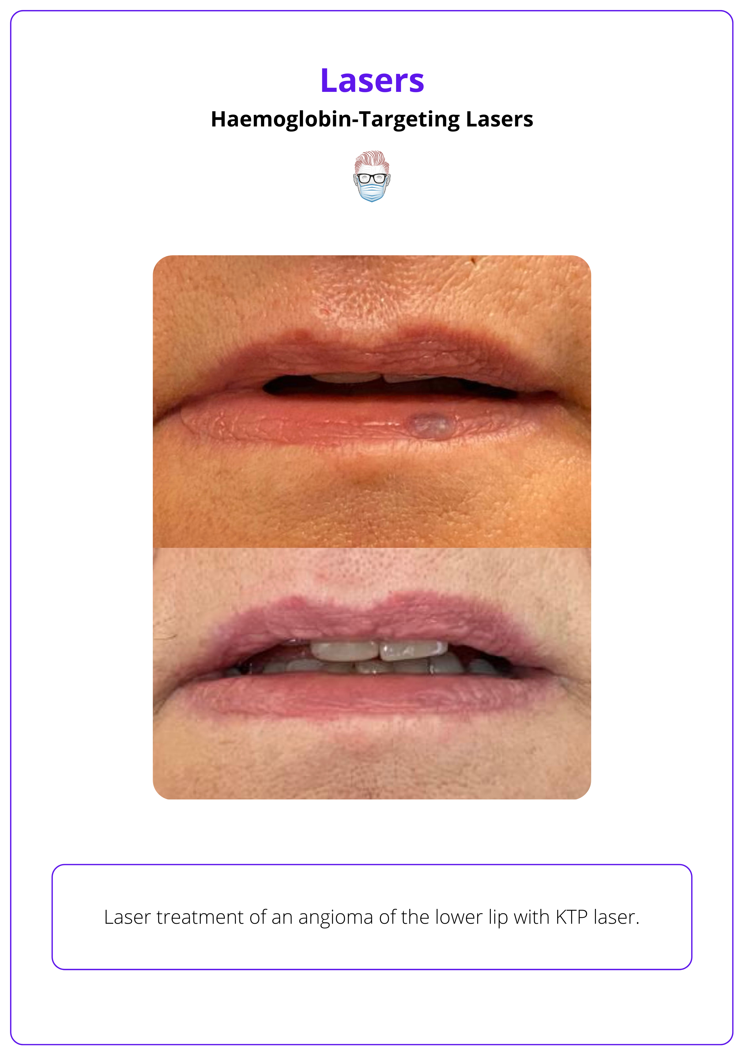 Pre- and post- laser treatment results of a lower lip angioma