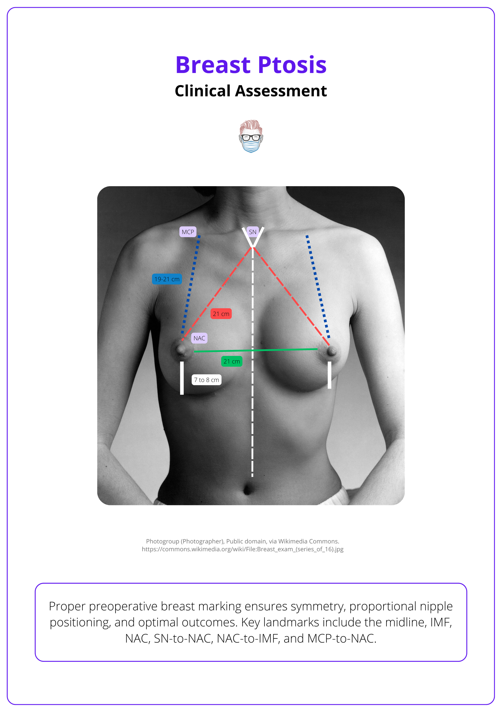 Preoperative breast marking for breast ptosis