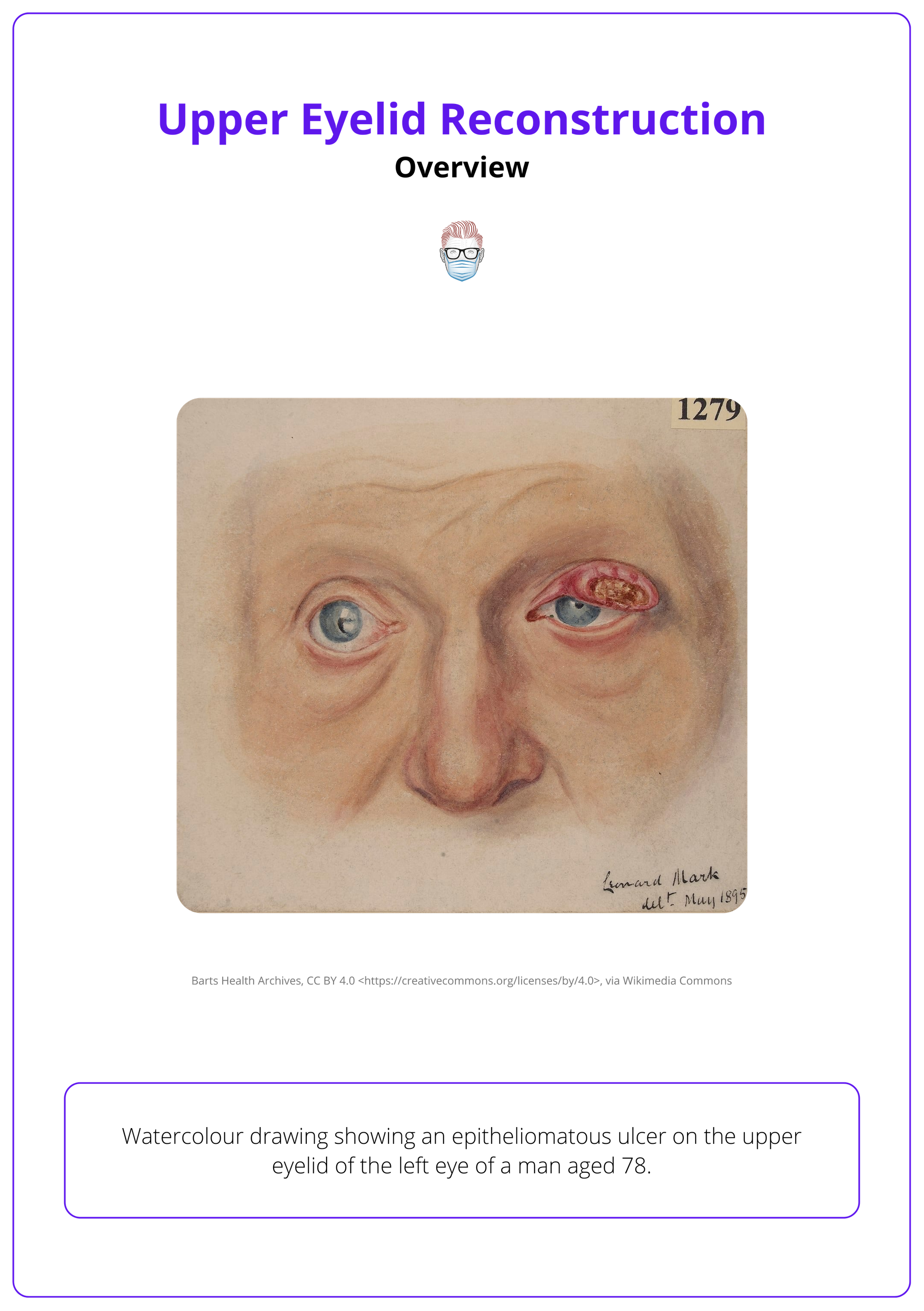 Left upper eyelid malignancy