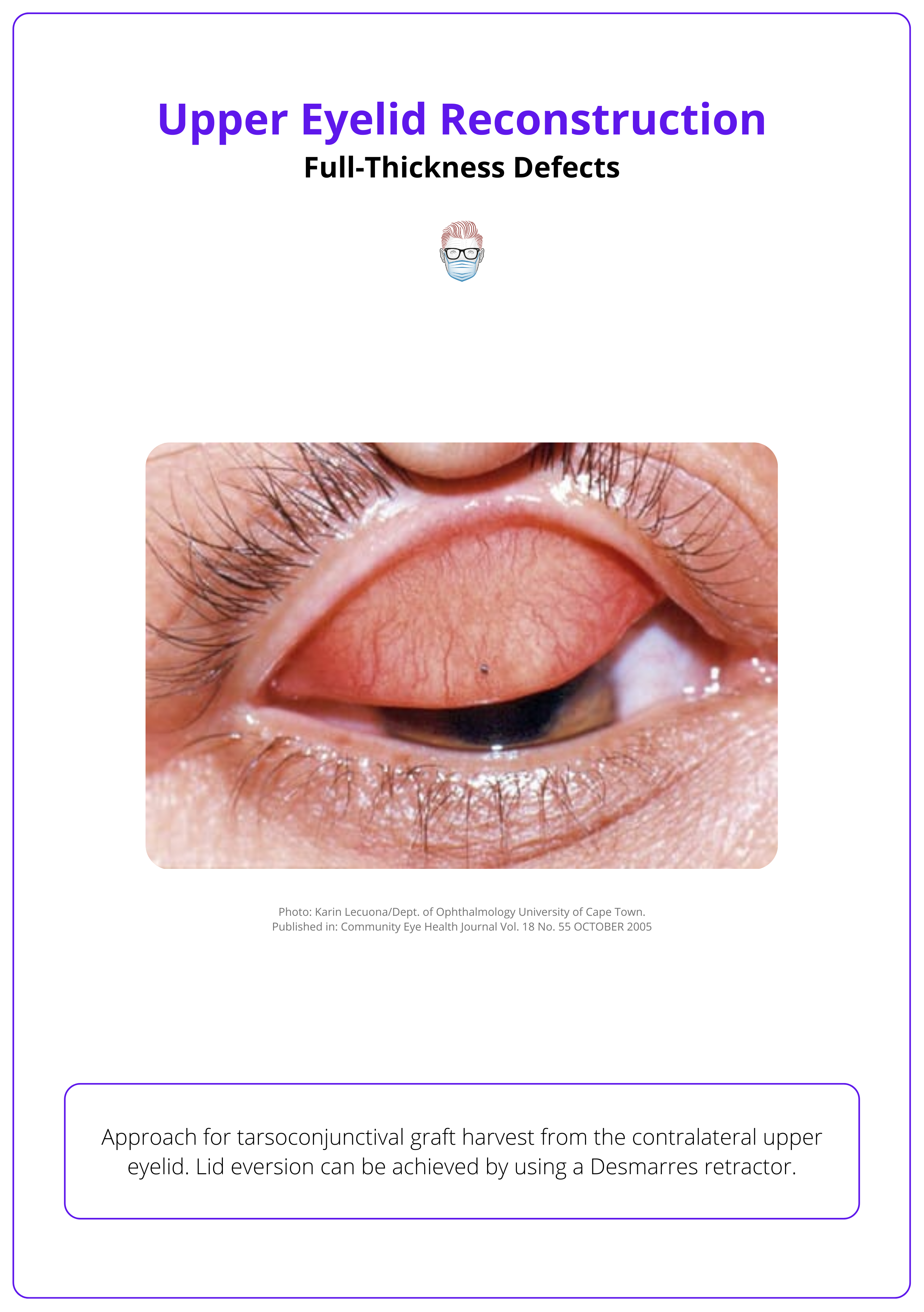 Clinical image of the everted upper eyelid